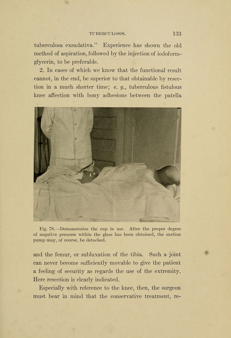 tuberculosa exsudativa. Experience has shown the old method of aspiration, followed by the injection of iodoform- glycerin, to be preferable. 2. In cases of which we know that the functional result cannot, in the end, be superior to that obtainable by resec- tion in a much shorter time; e. g., tuberculous fistulous knee affection with bony adhesions between the patella Fig. 78.—Demonstrates the cup in use. After the proper degree of negative pressure within the glass has been obtained, the suction pump may, of course, be detached. and the femur, or subluxation of the tibia. Such a joint can never become sufficiently movable to give the patient a feeling of security as regards the use of the extremity. Here resection is clearly indicated. Especially with reference to the knee, then, the surgeon must bear in mind that the conservative treatment, re-