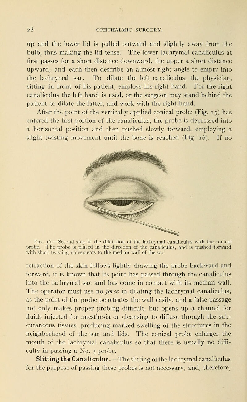 up and the lower lid is pulled outward and slightly away from the bulb, thus making the lid tense. The lower lachrymal canaliculus ät first passes for a short distance downward, the upper a short distance upward, and each then describe an almost right angle to empty into the lachrymal sac. To dilate the left canaliculus, the physician, sitting in front of his patient, employs his right hand. For the right canaliculus the left hand is used, or the surgeon may stand behind the patient to dilate the latter, and work with the right hand. After the point of the vertically applied conical probe (Fig. 15) has entered the first portion of the canaliculus, the probe is depressed into a horizontal position and then pushed slowly forward, employing a slight twisting movement until the bone is reached (Fig. 16). If no Fig. 16.—Second Step in the dilatation of the lachrymal canaliculus with the conical probe. The probe is placed in the direction of the canaliculus, and is pushed forward with short twisting movements to the median wall of the sac. retraction of the skin follows lightly drawing the probe backward and forward, it is known that its point has passed through the canaliculus into the lachrymal sac and has come in contact with its median wall. The Operator must use no force in dilating the lachrymal canaliculus, as the point of the probe penetrates the wall easily, and a false passage not only makes proper probing difhcult, but opens up a Channel for fluids injected for anesthesia or cleansing to diffuse through the sub- cutaneous tissues, producing marked swelling of the structures in the neighborhood of the sac and lids. The conical probe enlarges the mouth of the lachrymal canaliculus so that there is usually no diffi- culty in passing a No. 5 probe. Slitting the Canaliculus.—The slitting of the lachrymal canaliculus for the purpose of passing these probes is not necessary, and, therefore,