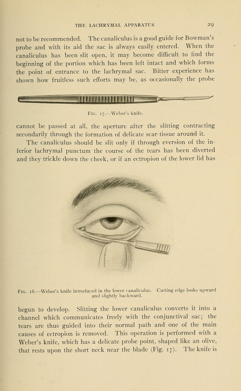 not to be recommended. The canaliculus is a good guide for Bowman's probe and with its aid the sac is always easily entered. When the canaliculus has been slit open, it may become difficult to find the beginning of the portion which has been left intact and which forms the point of entrance to the lachrymal sac. Bitter experience has shown how fruitless such efforts may be, as occasionally the probe Fig. 17.—Weber's knife. cannot be passed at all, the aperture after the slitting contracting secondarily through the formation of delicate scar-tissue around it. The canaliculus should be slit only if through eversion of the in- ferior lachrymal punctum the course of the tears has been diverted and they trickle down the cheek, or if an ectropion of the lower lid has Fig. 18.—Weber's knife introduced in the lower canaliculus. Cutting edge looks upward and slightly backward. begun to develop. Slitting the lower canaliculus converts it into a Channel which communicates freely with the conjunctival sac; the tears are thus guided into their normal path and one of the main causes of ectropion is removed. This Operation is performed with a Weber's knife, which has a delicate probe point, shaped like an olive, that rests upon the short neck near the blade (Fig. 17). The knife is