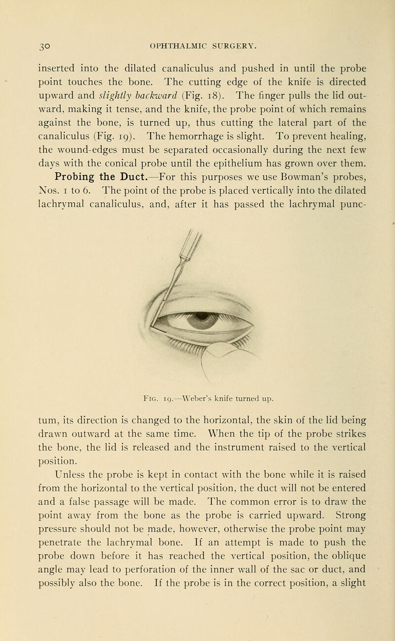 inserted into the dilated canaliculus and pushed in until the probe point touches the bone. The cutting edge of the knife is directed upward and slightly backward (Fig. 18). The finger pulls the lid out- ward, making it tense, and the knife, the probe point of which remains against the bone, is turned up, thus cutting the lateral part of the canaliculus (Fig. 19). The hemorrhage is slight. To prevent healing, the wound-edges must be separated occasionally during the next few days with the conical probe until the epithelium has grown over them. Probing the Duct.—For this purposes we use Bowman's probes, Nos. 1 to 6. The point of the probe is placed vertically into the dilated lachrymal canaliculus, and, after it has passed the lachrymal punc- FiG. 19.—Weber's knife turned up. tum, its direction is changed to the horizontal, the skin of the lid being drawn outward at the same time. When the tip of the probe strikes the bone, the lid is released and the instrument raised to the vertical position. Unless the probe is kept in contact with the bone while it is raised from the horizontal to the vertical position, the duct will not be entered and a false passage will be made. The common error is to draw the point away from the bone as the probe is carried upward. Strong pressure should not be made, however, otherwise the probe point may penetrate the lachrymal bone. If an attempt is made to push the probe down before it has reached the vertical position, the oblique angle may lead to Perforation of the inner wall of the sac or duct, and possibly also the bone. If the probe is in the correct position, a slight