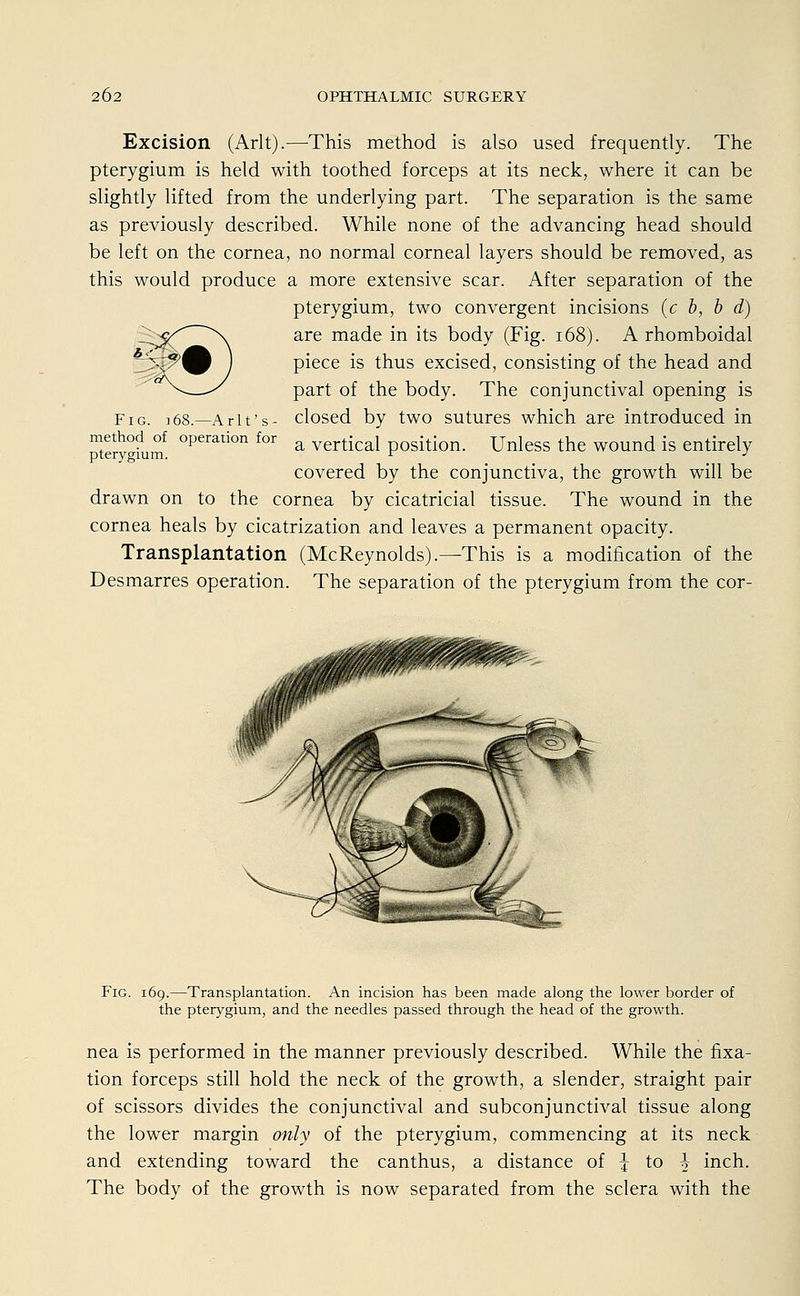 Excision (Arlt).—This method is also used frequently. The pterygium is held with toothed forceps at its neck, where it can be slightly lifted from the underlying part. The Separation is the same as previously described. While none of the advancing head should be left on the Cornea, no normal corneal layers should be removed, as this would produce a more extensive scar. After Separation of the pterygium, two convergent incisions (c b, b d) are made in its body (Fig. 168). A rhomboidal piece is thus excised, consisting of the head and part of the body. The conjunctival opening is closed by two sutures which are introduced in a vertical position. Unless the wound is entirely covered by the conjunctiva, the growth will be drawn on to the Cornea by cicatricial tissue. The wound in the Cornea heals by cicatrization and leaves a permanent opacity. Transplantation (McReynolds).—This is a modification of the Desmarres Operation. The Separation of the pterygium from the cor- Fig. i68—Arlt's- method of Operation for pterygium. Fig. 169.—Transplantation. An incision has been made along the lower border of the pterygium, and the needles passed through the head of the growth. nea is performed in the manner previously described. While the fixa- tion forceps still hold the neck of the growth, a slender, straight pair of scissors divides the conjunctival and subconjunctival tissue along the lower margin only of the pterygium, commencing at its neck and extending toward the canthus, a distance of j to | inch. The body of the growth is now separated from the sclera with the