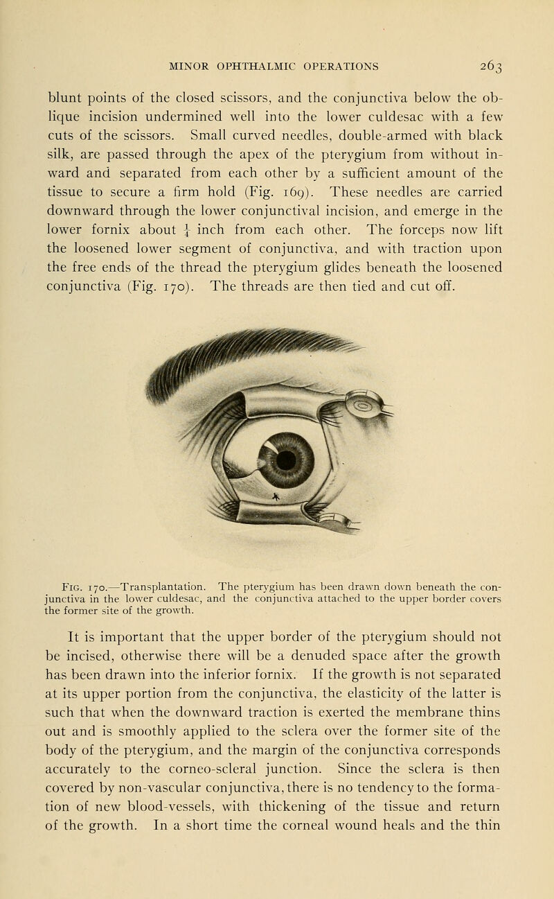 blunt points of the closed scissors, and the conjunctiva below the ob- lique incision undermined well into the lower culdesac with a few cuts of the scissors. Small curved needles, double-armed with black silk, are passed through the apex of the pterygium from without in- ward and separated from each other by a sufficient amount of the tissue to secure a firm hold (Fig. 169). These needles are carried downward through the lower conjunctival incision, and emerge in the lower fornix about \ inch from each other. The forceps now lift the loosened lower segment of conjunctiva, and with traction upon the free ends of the thread the pterygium glides beneath the loosened conjunctiva (Fig. 170). The threads are then tied and cut off. Fig. 170.—Transplantation. The pterygium has been drawn down beneath the con- junctiva in the lower culdesac, and the conjunctiva attached to the upper border Covers the former site of the growth. It is important that the upper border of the pterygium should not be incised, otherwise there will be a denuded space after the growth has been drawn into the inferior fornix. If the growth is not separated at its upper portion from the conjunctiva, the elasticity of the latter is such that when the downward traction is exerted the membrane thins out and is smoothly applied to the sclera over the former site of the body of the pterygium, and the margin of the conjunctiva corresponds accurately to the corneo-scleral junction. Since the sclera is then covered by non-vascular conjunctiva, there is no tendency to the forma- tion of new blood-vessels, with thickening of the tissue and return of the growth. In a short time the corneal wound heals and the thin