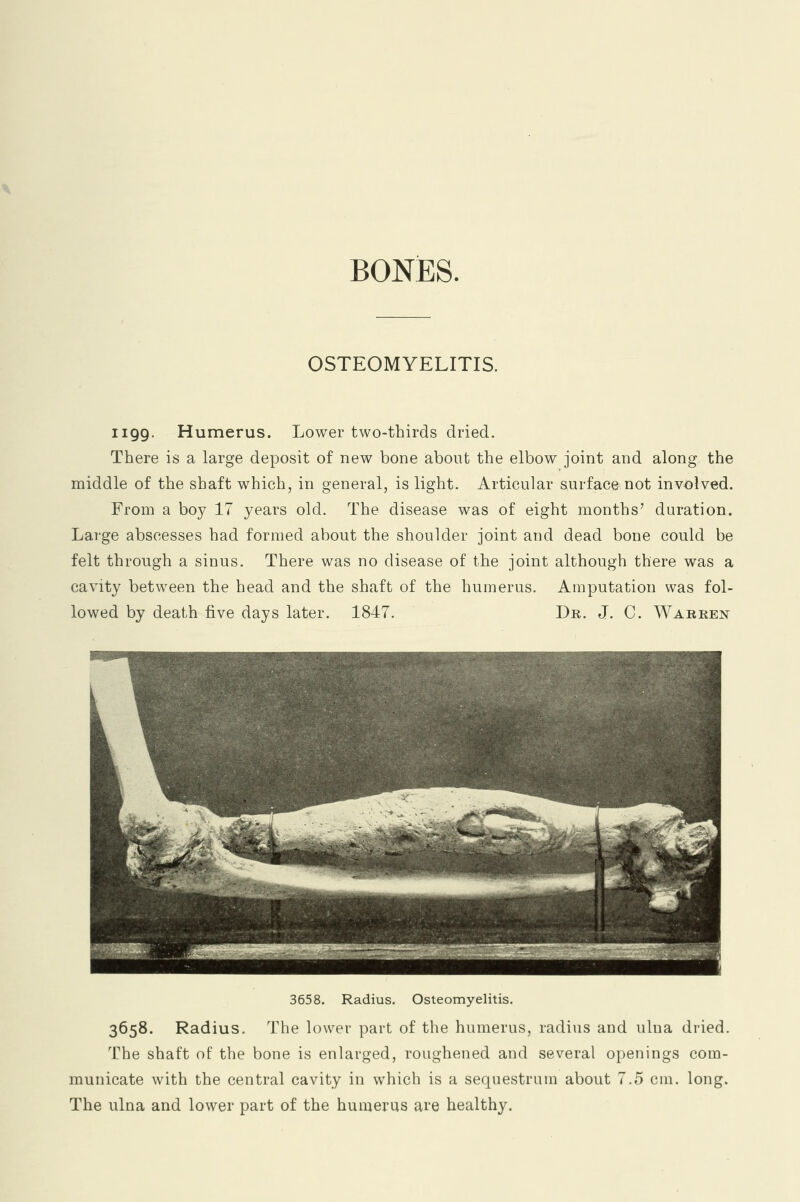 BONES. OSTEOMYELITIS. 1199. Humerus. Lower two-thirds dried. There is a large deposit of new bone about the elbow joint and along the middle of the shaft which, in general, is light. Articular surface not involved. From a boy 17 years old. The disease was of eight months' duration. Large abscesses had formed about the shoulder joint and dead bone could be felt through a sinus. There was no disease of the joint although there was a cavity between the head and the shaft of the humerus. Amputation was fol- lowed by death five days later. 1847. Dr. J. C. Warren 3658. Radius. Osteomyelitis. 3658. Radius. The lower part of the humerus, radius and ulna dried. The shaft of the bone is enlarged, roughened and several openings com- municate with the central cavity in which is a sequestrum about 7.5 cm. long. The ulna and lower part of the humerus are healthy.