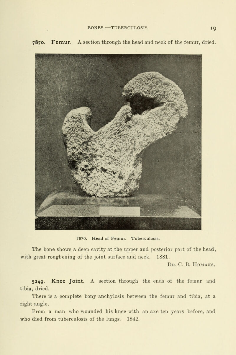 7870. Femur. A section through the head and neck of the femur, dried. 7870. Head of Femur. Tuberculosis. The bone shows a deep cavity at the upper and posterior part of the head, with great roughening of the joint surface and neck. 1881. Dk. C. B. Homans. 5249. Knee Joint. A section through the ends of the femur and tibia, dried. There is a complete bony anchylosis between the femur and tibia, at a right angle. From a man who wounded his knee with an axe ten years before, and who died from tuberculosis of the lungs. 1842,
