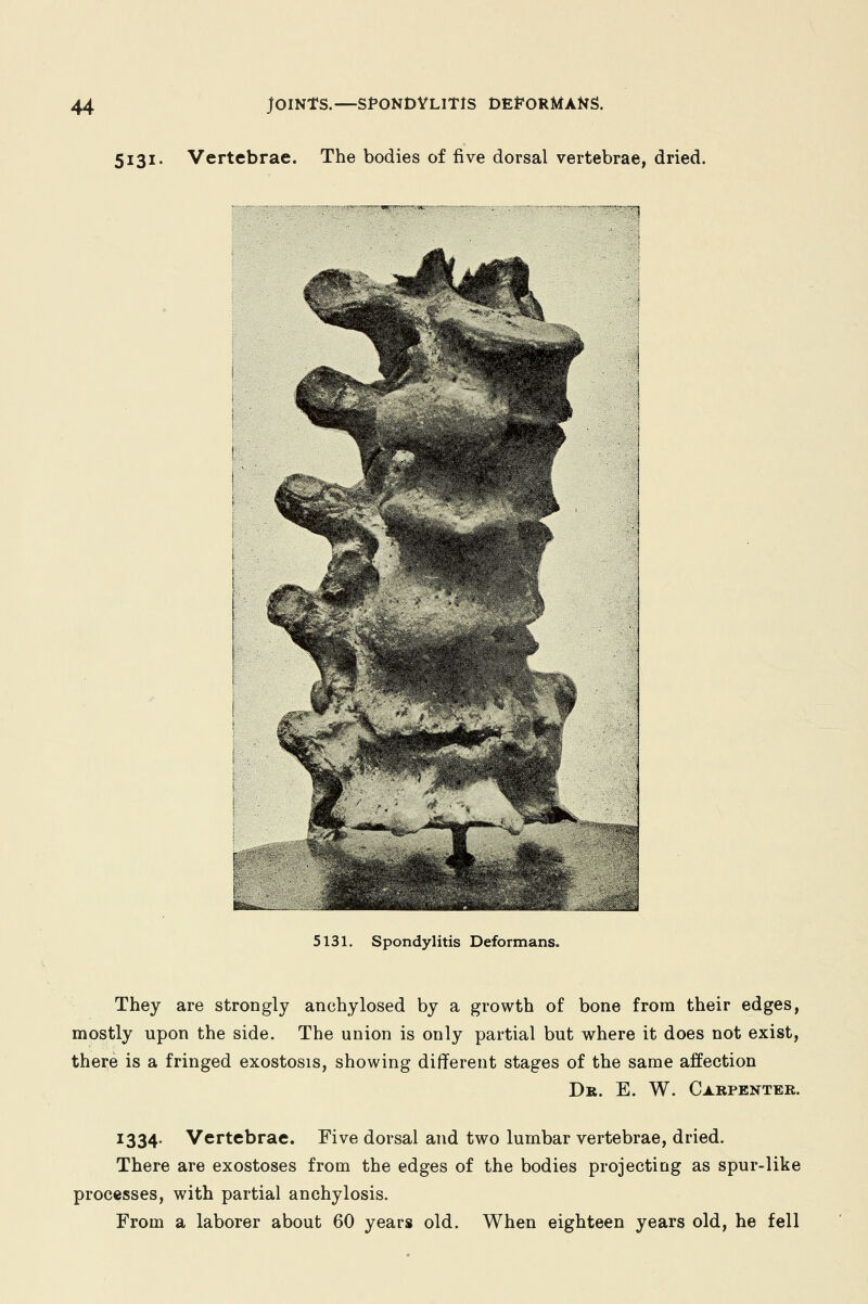 5131. Vertebrae. The bodies of five dorsal vertebrae, dried. 5131. Spondylitis Deformans. They are strongly anchylosed by a growth of bone from their edges, mostly upon the side. The union is only partial but where it does not exist, there is a fringed exostosis, showing different stages of the same affection Dr. E. W. Carpenter. 1334. Vertebrae. Five dorsal and two lumbar vertebrae, dried. There are exostoses from the edges of the bodies projecting as spur-like processes, with partial anchylosis. From a laborer about 60 years old. When eighteen years old, he fell