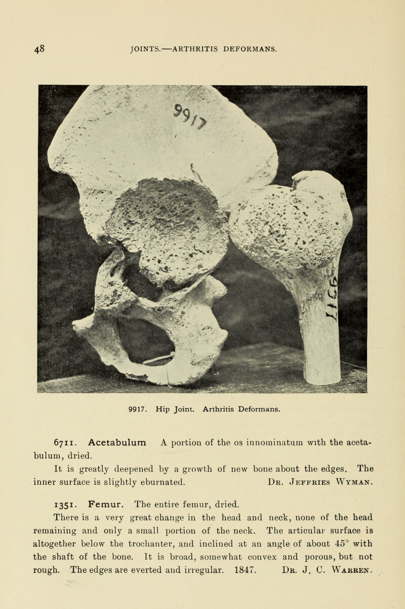 9917. Hip Joint. Arthritis Deformans. 6711. Acetabulum A portion of the os innominatum with the aceta- bulum, dried. It is greatly deepened by a growth of new bone about the edges. The inner surface is slightly eburnated. Dr. Jeffries Wyman. 1351. Femur. The entire femur, dried. There is a very great change in the head and neck, none of the head remaining and only a small portion of the neck. The articular surface is altogether below the trochanter, and inclined at an angle of about 45° with the shaft of the bone. It is broad, somewhat convex and porous, but not rough. The edges are everted and irregular. 1847. Dr. J. C. Warren.