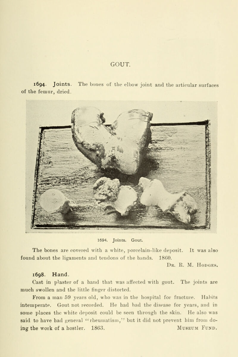 GOUT. 1694. Joints. The bones of the elbow joint and the articular surfaces of the femur, dried. 1694. Joints. Gout. The bones are covered with a white, porcelain-like deposit. It was also found about the ligaments and tendons of the hands. 1860. Dr. R. M. Hodges. 1698. Hand. Cast in plaster of a hand that was affected with gout. The joints are much swollen and the little finger distorted. From a man 59 years old, who was in the hospital for fracture. Habits intemperate. Gout not recorded. He had had the disease for years, and in some places the white deposit could be seen through the skin. He also was said to have had general rheumatism, but it did not prevent him from do- ing the work of a hostler. 1863. Museum Fund.