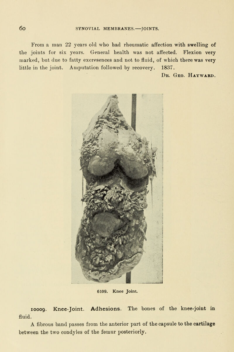 From a man 22 years old who had rheumatic affection with swelling of the joints for six years. General health was not affected. Flexion very marked, but due to fatty excresences and not to fluid, of which there was very little in the joint. Amputation followed by recovery. 1837. Dr. Geo. Hayward. 10009. Knee-joint. Adhesions. The bones of the knee-joint in fluid. A fibrous band passes from the anterior part of the capsule to the cartilage between the two condyles of the femur posteriorly.