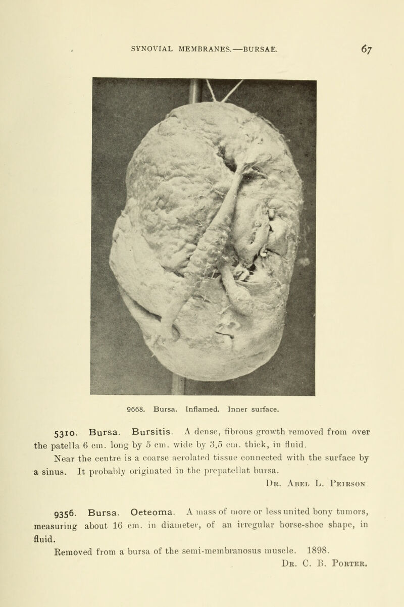 9668. Bursa. Inflamed. Inner surface. 5310. Bursa. Bursitis. A dense, fibrous growth removed from over the patella 6 cm. long by 5 cm. wide by 3.5 cm. thick, in fluid. Near the centre is a coarse aerolated tissue connected with the surface by a sinus. It probably originated in the prepatellat bursa. Dr. Abel L. Peirson 9356. Bursa. Oeteoma. Amass of more or less united bony tumors, measuring about 16 cm. in diameter, of an irregular horse-shoe shape, in fluid. Removed from a bursa of the semi-raembranosus muscle. 1898. Dr. C. B. Porter.