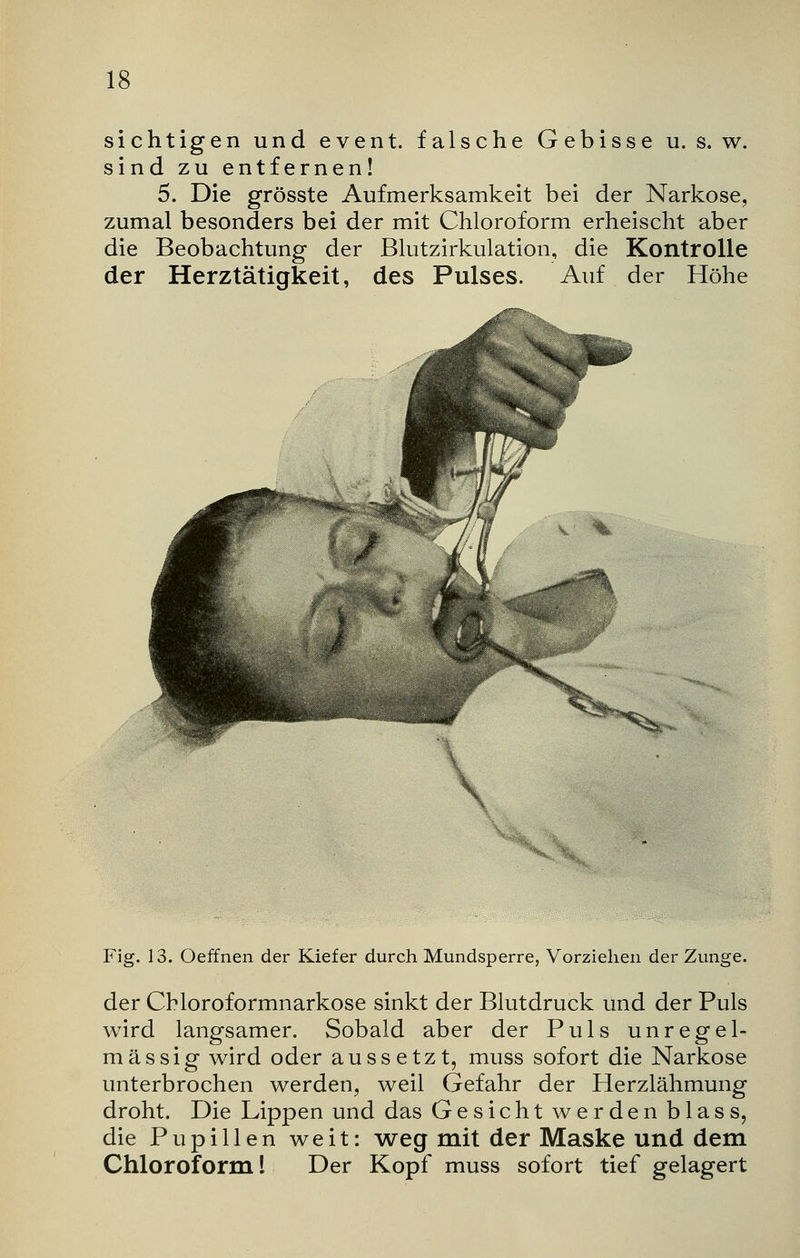 sichtigen und event. falsche Gebisse u. s. w. sind zu entfernen! 5. Die grösste Aufmerksamkeit bei der Narkose, zumal besonders bei der mit Chloroform erheischt aber die Beobachtung der Blutzirkulation, die Kontrolle der Herztätigkeit, des Pulses. Auf der Höhe Fig. 13. Oeffnen der Kiefer durch Mundsperre, Vorziehen der Zunge. der Chloroformnarkose sinkt der Blutdruck und der Puls wird langsamer. Sobald aber der Puls unregel- mässig wird oder aussetzt, muss sofort die Narkose unterbrochen werden, weil Gefahr der Herzlähmung droht. Die Lippen und das Gesicht werden blass, die Pupillen weit: weg mit der Maske und dem Chloroform! Der Kopf muss sofort tief gelagert