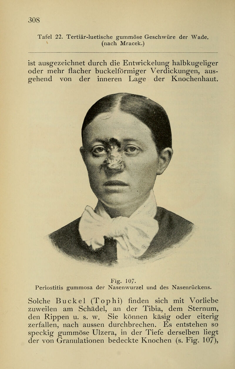 Tafel 22. Tertiär-luetische gummöse Geschwüre der Wade, (nach Mracek.) ist ausgezeichnet durch die Entwickelung halbkugeliger oder mehr flacher buckeiförmiger Verdickungen, aus- gehend von der inneren Lage der Knochenhaut. Fig. 107- Periostitis gummosa der Nasenwurzel und des Nasenrückens. Solche Buckel (Tophi) finden sich mit Vorliebe zuweilen am Schädel, an der Tibia, dem Sternum, den Rippen u. s. w. Sie können käsig oder eiterig zerfallen, nach aussen durchbrechen. Es entstehen so speckig gummöse Ulzera, in der Tiefe derselben liegt der von Granulationen bedeckte Knochen (s. Fig. 107),