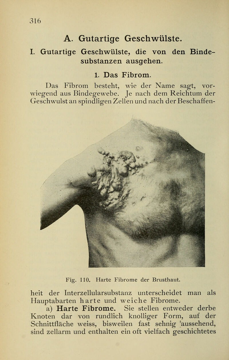 A. Gutartige Geschwülste. I. Gutartige Geschwülste, die von den Binde- substanzen ausgehen. 1. Das Fibrom. Das Fibrom besteht, wie der Name sagt, vor- wiegend aus Bindegewebe. Je nach dem Reichtum der Geschwulst an spindligen Zellen und nach der Beschaff en- Fig. 110. Harte Fibrome der Brusthaut. heit der Interzellularsubstanz unterscheidet man als Hauptabarten harte und weiche Fibrome. a) Harte Fibrome. Sie stellen entweder derbe Knoten dar von rundlich knolliger Form, auf der Schnittfläche weiss, bisweilen fast sehnig aussehend, sind zellarm und enthalten ein oft vielfach geschichtetes