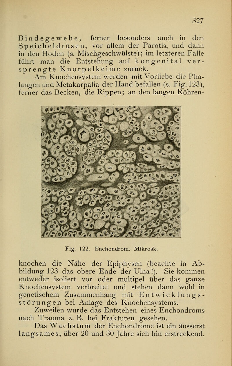 Bindegewebe, ferner besonders auch in den Speicheldrüsen, vor allem der Parotis, und dann in den Hoden (s. Mischgeschwülste); im letzteren Falle führt man die Entstehung auf kongenital ver- sprengte Knorpelkeime zurück. Am Knochensystem werden mit Vorliebe die Pha- langen und Metakarpalia der Hand befallen (s. Fig. 123), ferner das Becken, die Rippen; an den langen Röhren- Fig. 122. Enchondrom. Mikrosk. knochen die Nähe der Epiphysen (beachte in Ab- bildung 123 das obere Ende derUlna!). Sie kommen entweder isoliert vor oder multipel über das ganze Knochensystem verbreitet und stehen dann wohl in genetischem Zusammenhang mit Entwicklungs- störungen bei Anlage des Knochensystems. Zuweilen wurde das Entstehen eines Enchondroms nach Trauma z. B. bei Frakturen gesehen. Das Wachstum der Enchondrome ist ein äusserst langsames, über 20 und 30 Jahre sich hin erstreckend.