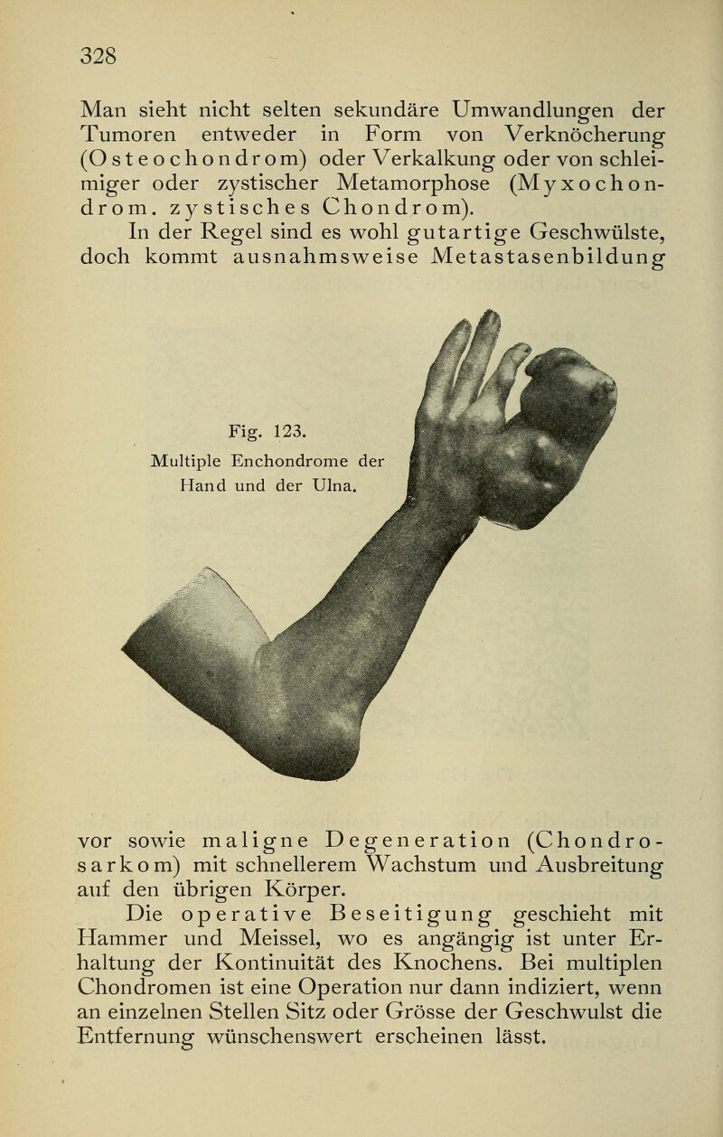 Man sieht nicht selten sekundäre Umwandlungen der Tumoren entweder in Form von Verknöcherung (Osteochondrom) oder Verkalkung oder von schlei- miger oder zystischer Metamorphose (MyxoChon- drom, zystisches Chondrom). In der Regel sind es wohl gutartige Geschwülste, doch kommt ausnahmsweise Metastasenbildung Fig. 123. Multiple Enchondrome der Hand und der Ulna. ex vor sowie maligne Degeneration (Chondro- sarkom) mit schnellerem Wachstum und Ausbreitung auf den übrigen Körper. Die operative Beseitigung geschieht mit Hammer und Meissel, wo es angängig ist unter Er- haltung der Kontinuität des Knochens. Bei multiplen Chondromen ist eine Operation nur dann indiziert, wenn an einzelnen Stellen Sitz oder Grösse der Geschwulst die Entfernung wünschenswert erscheinen lässt.