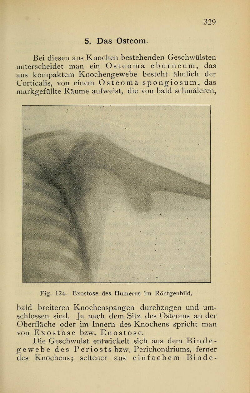 5. Das Osteom. Bei diesen aus Knochen bestehenden Geschwülsten unterscheidet man ein Osteoma eburneum, das aus kompaktem Knochengewebe besteht ähnlich der Corticalis, von einem Osteoma spongiosum, das markgefüllte Räume aufweist, die von bald schmäleren, Fig. 124. Exostose des Humerus im Röntgenbild. bald breiteren Knochenspangen durchzogen und um- schlossen sind. Je nach dem Sitz des Osteoms an der Oberfläche oder im Innern des Knochens spricht man von Exostose bzw. Enostose. Die Geschwulst entwickelt sich aus dem Binde- gewebe des Periosts bzw. Perichondriums, ferner des Knochens: seltener aus einfachem Binde-