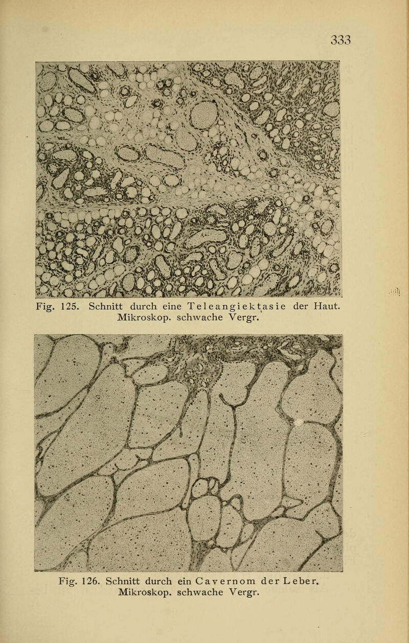 •¥v<f ■~S.fK-J- ■ irs'-Ä.,'' /-, ~< -. 'rx Fig. 125. Schnitt durch eine Teleangiektasie der Haut. Mikroskop, schwache Vergr. ^S Fig. 126. Schnitt durch einCavernom der Leber. Mikroskop, schwache Vergr.