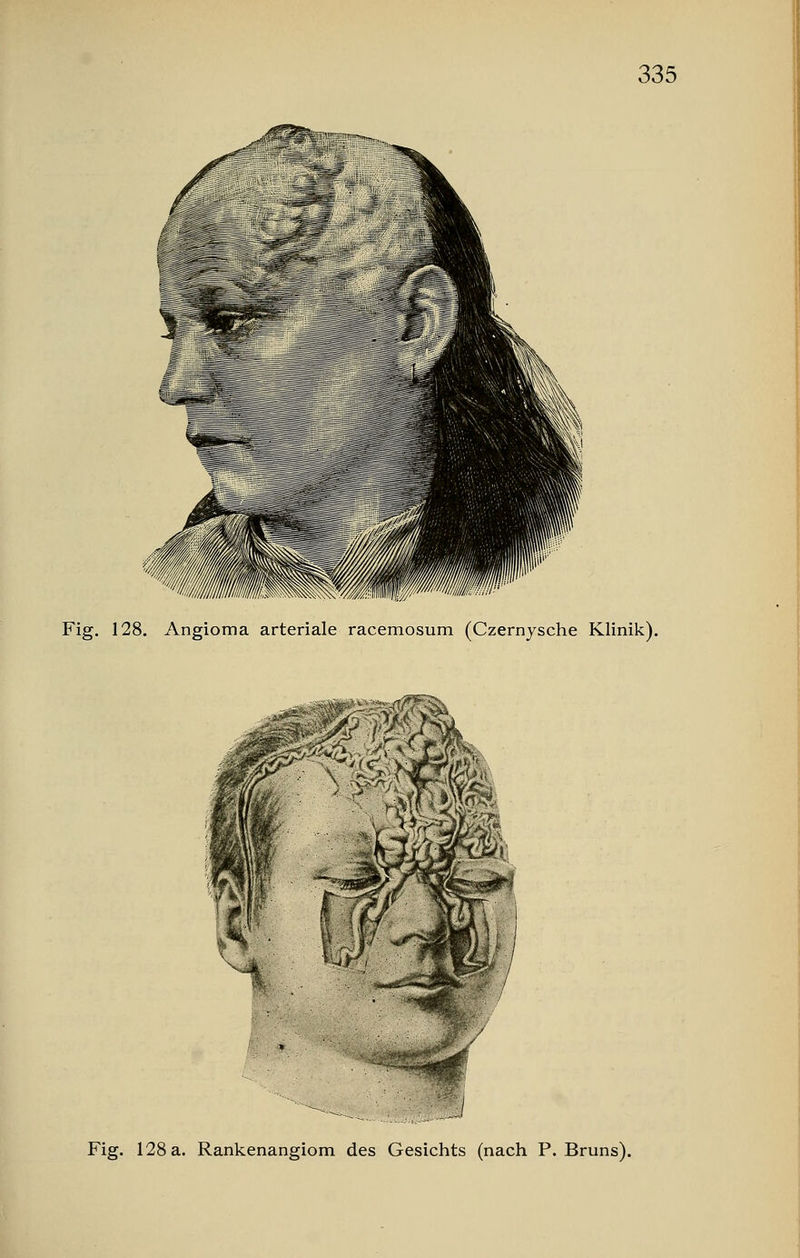 Fig. 128. Angioma arteriale racemosum (Czernysche Klinik). Fig. 128 a. Rankenangiom des Gesichts (nach P. Bruns).