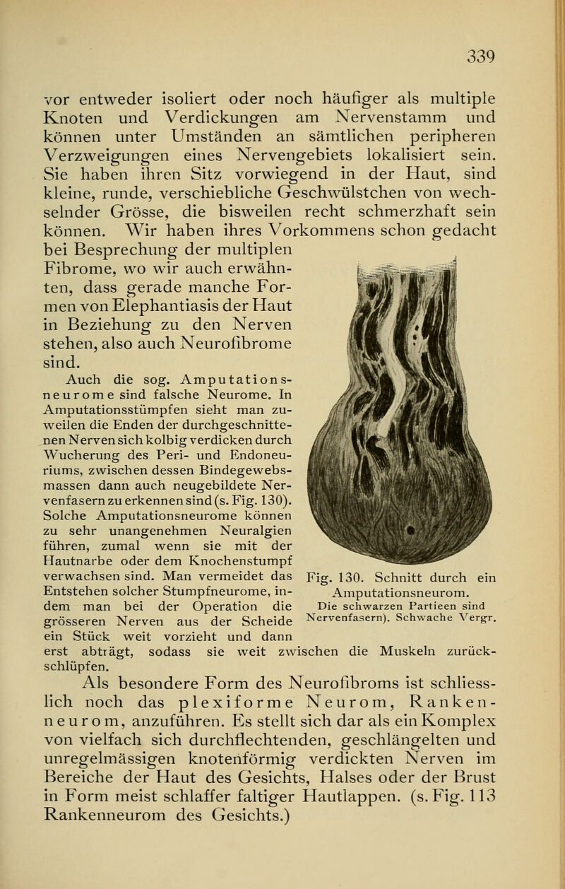 vor entweder isoliert oder noch häufiger als multiple Knoten und Verdickungen am Nervenstamm und können unter Umständen an sämtlichen peripheren Verzweigungen eines Nervengebiets lokalisiert sein. Sie haben ihren Sitz vorwiegend in der Haut, sind kleine, runde, verschiebliche Geschwülstchen von wech- selnder Grösse, die bisweilen recht schmerzhaft sein können. Wir haben ihres Vorkommens schon gedacht bei Besprechung der multiplen Fibrome, wo wir auch erwähn- ten, dass gerade manche For- men von Elephantiasis der Haut in Beziehung zu den Nerven stehen, also auch Neurofibrome sind. Auch die sog. Amputation s- neuromesind falsche Neurome. In Amputationsstümpfen sieht man zu- weilen die Enden der durchgeschnitte- nen Nerven sich kolbig verdicken durch Wucherung des Peri- und Endoneu- riums, zwischen dessen Bindegewebs- massen dann auch neugebildete Ner- venfasern zu erkennen sind (s. Fig. 130). Solche Amputationsneurome können zu sehr unangenehmen Neuralgien führen, zumal wenn sie mit der Hautnarbe oder dem Knochenstumpf verwachsen sind. Man vermeidet das Entstehen solcher Stumpfneurome, in- dem man bei der Operation die grösseren Nerven aus der Scheide ein Stück weit vorzieht und dann erst abträgt, sodass sie weit zwischen die Muskeln zurück- schlüpfen. Als besondere Form des Neurofibroms ist schliess- lich noch das plexiforme Neurom, Ranken- ne u r o m, anzuführen. Es stellt sich dar als ein Komplex von vielfach sich durchflechtenden, geschlängelten und unregelmässigen knotenförmig verdickten Nerven im Bereiche der Haut des Gesichts, Halses oder der Brust in Form meist schlaffer faltiger Hautlappen. (s.Fig. 113 Rankenneurom des Gesichts.) Fig. 130. Schnitt durch ein Amputationsneurom. Die schwarzen Partieen sind Nervenfasern). Schwache Vergr.