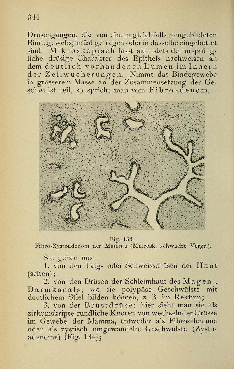 Drüsengängen, die von einem gleichfalls neugebildeten Bindegewebsgerüst getragen oder in dasselbe eingebettet sind. Mikroskopisch lässt sich stets der ursprüng- liche drüsige Charakter des Epithels nachweisen an dem deutlich vorhanden en Lumen im Inne rn der Zellwucherungen. Nimmt das Bindegewebe in grösserem Masse an der Zusammensetzung der Ge- schwulst teil, so spricht man vom Fibroadenom. .'-■/£ ■ §§?W5e§?«*'r .-*-s■•.'v' '•',.''.y•''-i'- Fig. 134. Fibro-Zystoadenom der Mamma (Mikrosk. schwache Vergr.). Sie gehen aus 1. von den Talg- oder Schweissdrüsen der Haut (selten); 2. von den Drüsen der Schleimhaut des Magen-, Darmkanals, wo sie polypöse Geschwülste mit deutlichem Stiel bilden können, z. B. im Rektum; 3. von der Brustdrüse; hier sieht man sie als zirkumskripte rundliche Knoten von wechselnder Grösse im Gewebe der Mamma, entweder als Fibroadenome oder als zystisch umgewandelte Geschwülste (Zyst- adenome) (Fig. 134);