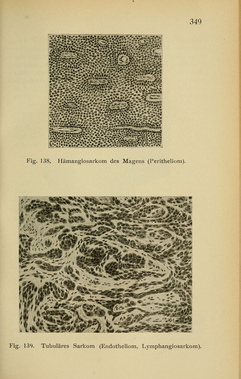 Fig. 138. Hämangiosarkom des Magens (Peritheliom).