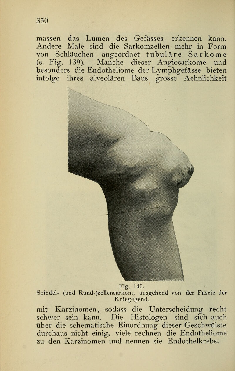 massen das Lumen des Gefässes erkennen kann. Andere Male sind die Sarkomzellen mehr in Form von Schläuchen angeordnet tubuläre Sarkome (s. Fig. 139). Manche dieser Angiosarkome und besonders die Endotheliome der Lymphgefässe bieten infolge ihres alveolären Baus grosse Aehnlichkeit Fig. 140. Spindel- (und Rund-)zellensarkom, ausgehend von der Fascie der Kniegegend. mit Karzinomen, sodass die Unterscheidung recht schwer sein kann. Die Histologen sind sich auch über die schematische Einordnung dieser Geschwülste durchaus nicht einig, viele rechnen die Endotheliome zu den Karzinomen und nennen sie Endothelkrebs.