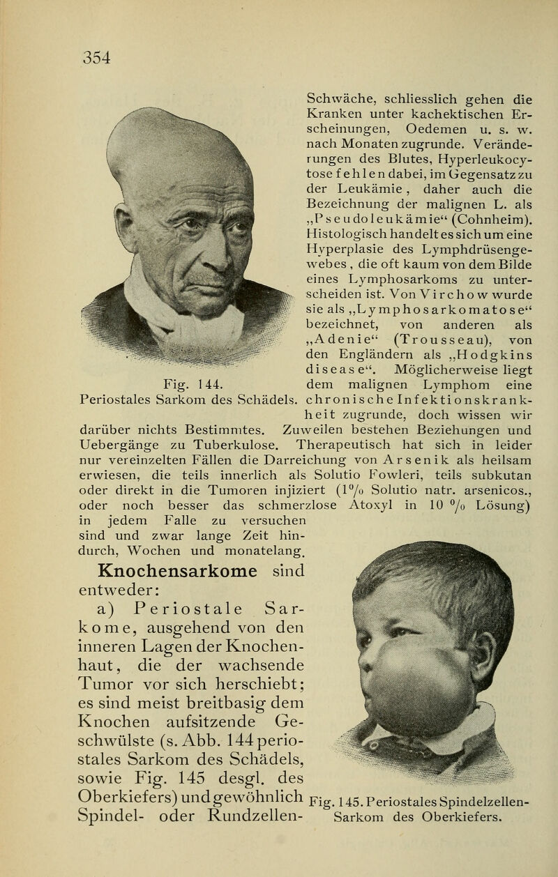 / Fig. 144. Periostales Sarkom des Schädels. Schwäche, schliesslich gehen die Kranken unter kachektischen Er- scheinungen, Oedemen u. s. w. nach Monaten zugrunde. Verände- rungen des Blutes, Hyperleukocy- tose fehlen dabei, im Gegensatz zu der Leukämie, daher auch die Bezeichnung der malignen L. als „Pseudoleukämie (Cohnheim). Histologisch handelt es sich um eine Hyperplasie des Lymphdrüsenge- webes , die oft kaum von dem Bilde eines Lymphosarkoms zu unter- scheiden ist. Von Virchow wurde sie als „Lymphosarkomatose bezeichnet, von anderen als ,,Adenie (Trousseau), von den Engländern als „Hodgkins disease. Möglicherweise liegt dem malignen Lymphom eine chronische Infektionskrank- heit zugrunde, doch wissen wir darüber nichts Bestimmtes. Zuweilen bestehen Beziehungen und Uebergänge zu Tuberkulose. Therapeutisch hat sich in leider nur vereinzelten Fällen die Darreichung von Arsenik als heilsam erwiesen, die teils innerlich als Solutio Fowleri, teils subkutan oder direkt in die Tumoren injiziert (l°/o Solutio natr. arsenicos., oder noch besser das schmerzlose Atoxyl in 10 °/o Lösung) in jedem Falle zu versuchen sind und zwar lange Zeit hin- durch, Wochen und monatelang. Knochensarkome sind entweder: a) Periostale Sar- kome, ausgehend von den inneren Lagen der Knochen- haut, die der wachsende Tumor vor sich herschiebt; es sind meist breitbasig dem Knochen aufsitzende Ge- schwülste (s. Abb. 144 perio- stales Sarkom des Schädels, sowie Fig. 145 desgl. des Oberkiefers) und gewöhnlich Fig< 145. Periostales Spindelzellen- Spindel- oder Rundzellen- Sarkom des Oberkiefers.