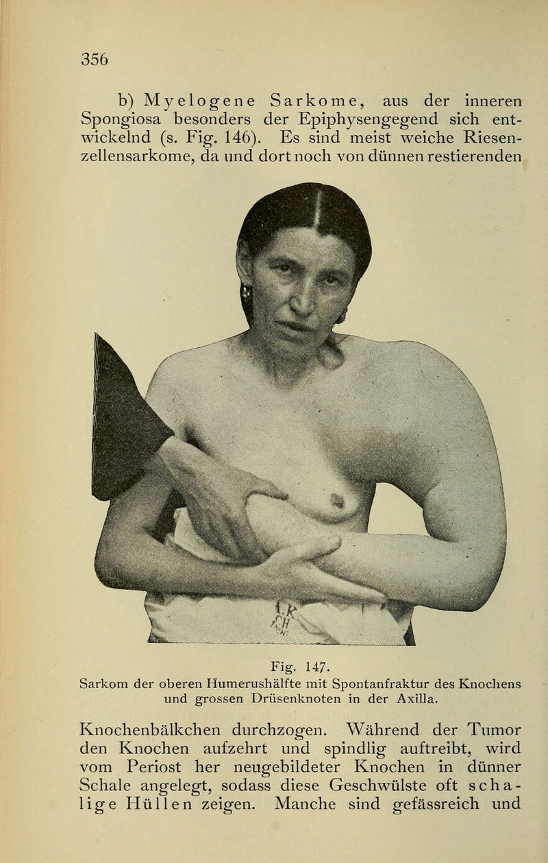 b) Myelogene Sarkome, aus der inneren Spongiosa besonders der Epiphysengegend sich ent- wickelnd (s. Fig. 146). Es sind meist weiche Riesen- zellensarkome, da und dort noch von dünnen restierenden Fig. 147. Sarkom der oberen Humerushälfte mit Spontanfraktur des Knochens und grossen Drüsenknoten in der Axilla. Knochenbälkchen durchzogen. Während der Tumor den Knochen aufzehrt und spindlig auftreibt, wird vom Periost her neugebildeter Knochen in dünner Schale angelegt, sodass diese Geschwülste oft scha- lige Hüllen zeigen. Manche sind gefässreich und