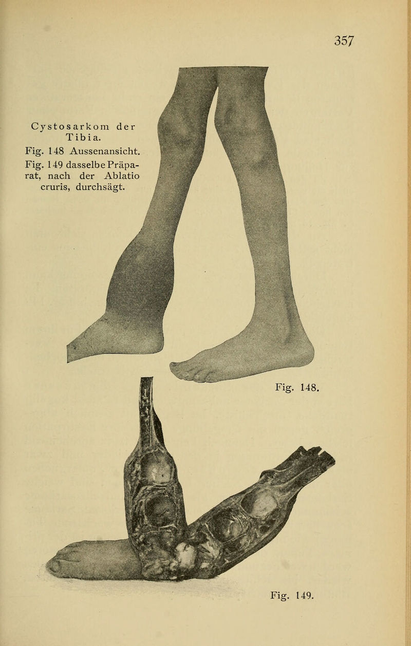 Cystosarkom der Tibia. Fig. 148 Aussenansicht. Fig. 149 dasselbe Präpa- rat, nach der Ablatio cruris, durchsägt. Fig. 149.