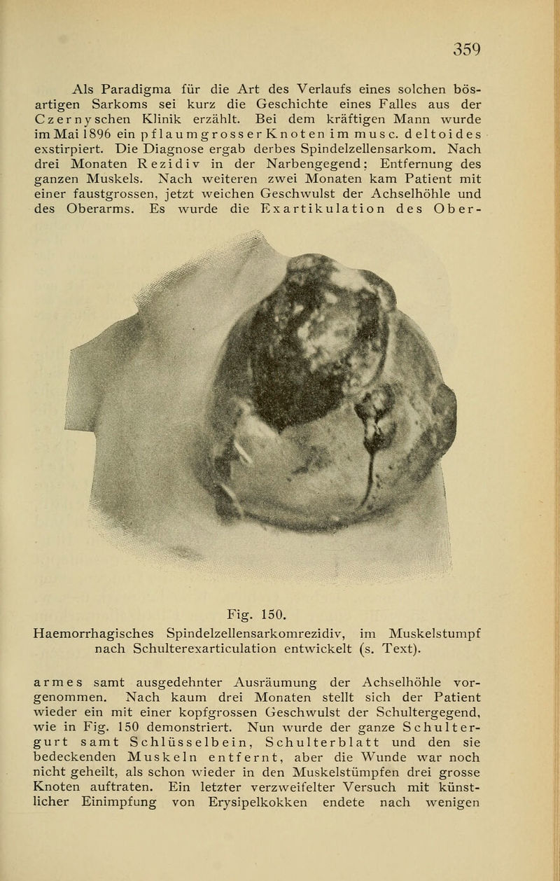 Als Paradigma für die Art des Verlaufs eines solchen bös- artigen Sarkoms sei kurz die Geschichte eines Falles aus der Cz er ny sehen Klinik erzählt. Bei dem kräftigen Mann wurde im Mai 1896 ein pflaumgrosserKnoten im musc. deltoides exstirpiert. Die Diagnose ergab derbes Spindelzellensarkom. Nach drei Monaten Rezidiv in der Narbengegend; Entfernung des ganzen Muskels. Nach weiteren zwei Monaten kam Patient mit einer faustgrossen, jetzt weichen Geschwulst der Achselhöhle und des Oberarms. Es wurde die Exartikulation des Ober- Fig. 150. Haemorrhagisches Spindelzellensarkomrezidiv, im Muskelstumpf nach Schulterexarticulation entwickelt (s. Text). armes samt ausgedehnter Ausräumung der Achselhöhle vor- genommen. Nach kaum drei Monaten stellt sich der Patient wieder ein mit einer kopfgrossen Geschwulst der Schultergegend, wie in Fig. 150 demonstriert. Nun wurde der ganze Schulter- gurt samt Schlüsselbein, Schulterblatt und den sie bedeckenden Muskeln entfernt, aber die Wunde war noch nicht geheilt, als schon wieder in den Muskelstümpfen drei grosse Knoten auftraten. Ein letzter verzweifelter Versuch mit künst- licher Einimpfung von Erysipelkokken endete nach wenigen