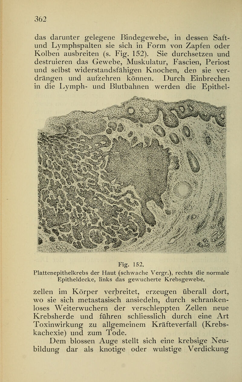 das darunter gelegene Bindegewebe, in dessen Saft- und Lymphspalten sie sich in Form von Zapfen oder Kolben ausbreiten (s. Fig. 152). Sie durchsetzen und destruieren das Gewebe, Muskulatur, Fascien, Periost und selbst widerstandsfähigen Knochen, den sie ver- drängen und aufzehren können. Durch Einbrechen in die Lymph- und Blutbahnen werden die Epithel- ----- Fig. 152. Plattenepithelkrebs der Haut (schwache Vergr.), rechts die normale Epitheldecke, links das gewucherte Krebsgewebe. zellen im Körper verbreitet, erzeugen überall dort, wo sie sich metastasisch ansiedeln, durch schranken- loses Weiterwuchern der verschleppten Zellen neue Krebsherde und führen schliesslich durch eine Art Toxinwirkung zu allgemeinem Kräfteverfall (Krebs- kachexie) und zum Tode. Dem blossen Auge stellt sich eine krebsige Neu- bildung dar als knotige oder wulstige Verdickung