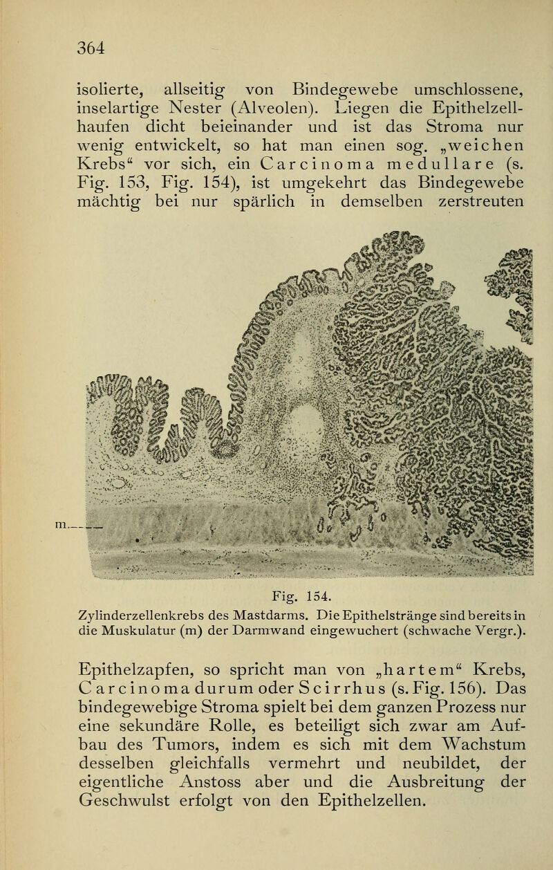 isolierte, allseitig von Bindegewebe umschlossene, inselartige Nester (Alveolen). Liegen die Epithelzell- haufen dicht beieinander und ist das Stroma nur wenig entwickelt, so hat man einen sog. „weichen Krebs vor sich, ein Carcinoma medulläre (s. Fig. 153, Fig. 154), ist umgekehrt das Bindegewebe mächtig bei nur spärlich in demselben zerstreuten Fig. 154. Zylinderzellenkrebs des Mastdarms. Die Epithelstränge sind bereits in die Muskulatur (m) der Darmwand eingewuchert (schwache Vergr.). Epithelzapfen, so spricht man von „hartem Krebs, Carcinoma durum oder Scirrhus (s. Fig. 156). Das bindegewebige Stroma spielt bei dem ganzen Prozess nur eine sekundäre Rolle, es beteiligt sich zwar am Auf- bau des Tumors, indem es sich mit dem Wachstum desselben gleichfalls vermehrt und neubildet, der eigentliche Anstoss aber und die Ausbreitung der Geschwulst erfolgt von den Epithelzellen.