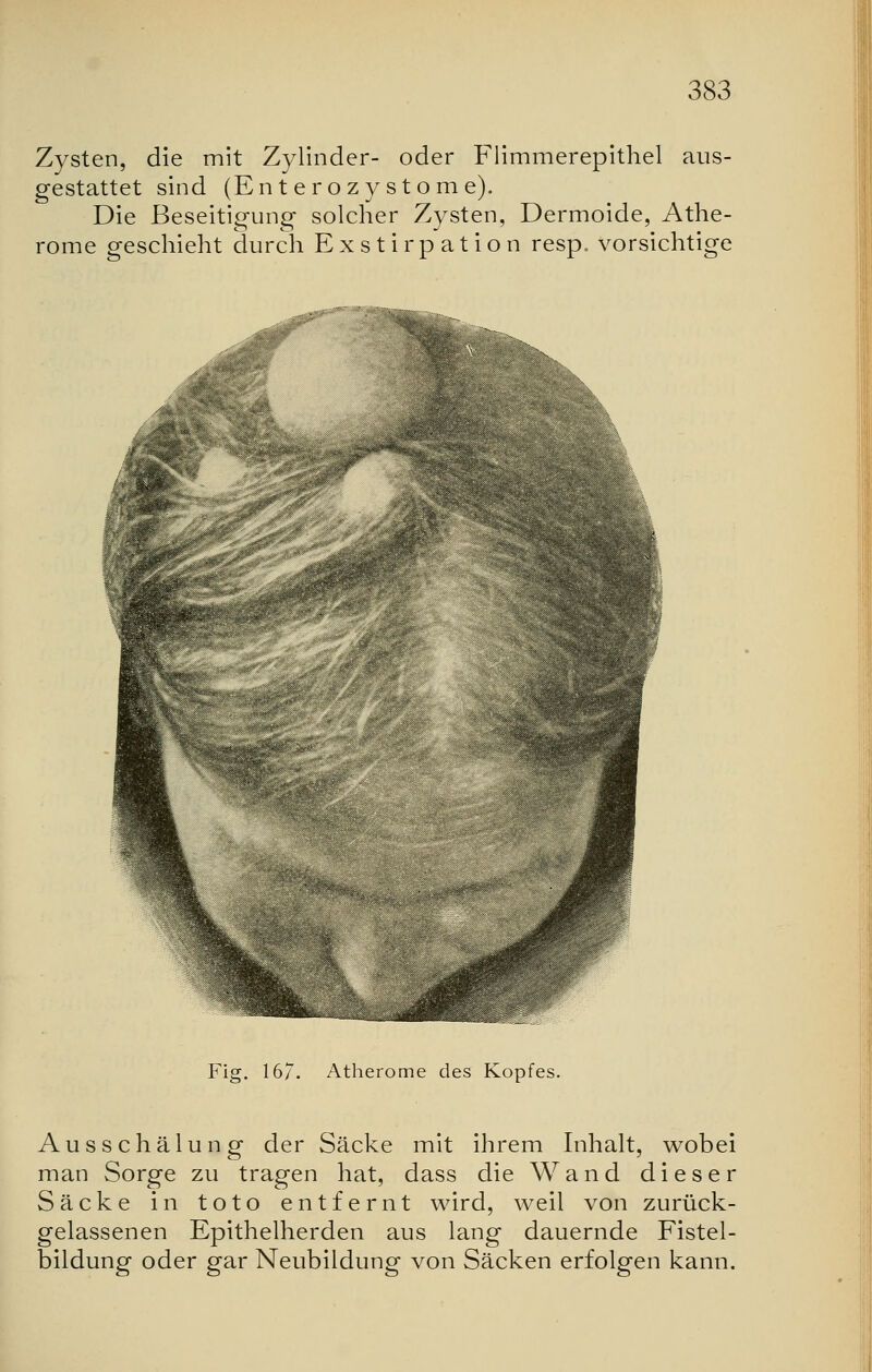 Zysten, die mit Zylinder- oder Flimmerepithel aus- gestattet sind (Ent erozy st om e). Die Beseitigung solcher Zysten, Dermoide, Athe- rome geschieht durch Exstirpation resp. vorsichtige Fig. 167. Atherome des Kopfes. Ausschälung der Säcke mit ihrem Inhalt, wobei man Sorge zu tragen hat, dass die Wand dieser Säcke in toto entfernt wird, weil von zurück- gelassenen Epithelherden aus lang dauernde Fistel- bildung oder gar Neubildung von Säcken erfolgen kann.