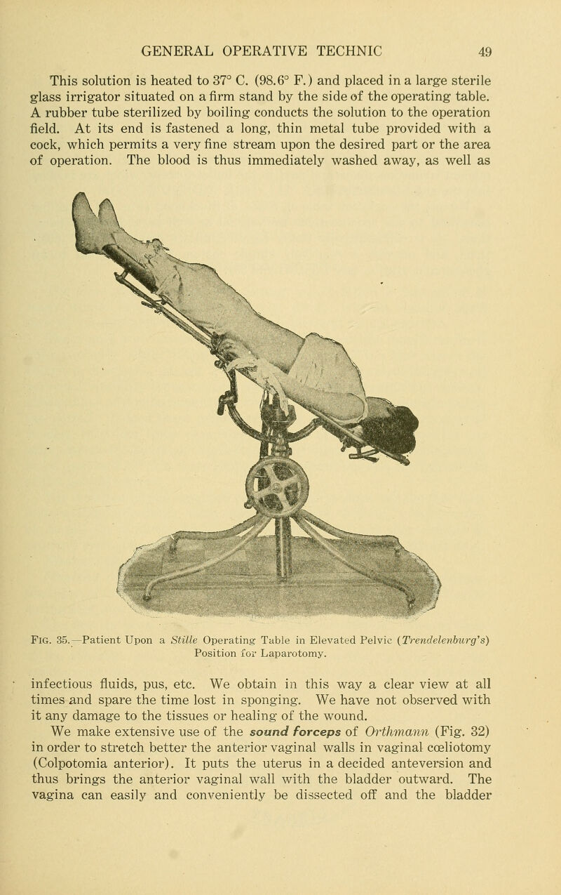 This solution is heated to 37° C. (98.6° F.) and placed in a large sterile glass irrigator situated on a firm stand by the side of the operating table. A rubber tube sterilized by boiling conducts the solution to the operation field. At its end is fastened a long, thin metal tube provided with a cock, which permits a very fine stream upon the desired part or the area of operation, The blood is thus immediately washed away, as well as Ik Fig. 35.—Patient Upon a Stille Operating Table in Elevated Pelvic (Trendelenburg's) Position for Laparotomy. infectious fluids, pus, etc. We obtain in this way a clear view at all times and spare the time lost in sponging. We have not observed with it any damage to the tissues or healing of the wound. We make extensive use of the sound forceps of Orthmann (Fig. 32) in order to stretch better the anterior vaginal walls in vaginal coeliotomy (Colpotomia anterior). It puts the uterus in a decided anteversion and thus brings the anterior vaginal wall with the bladder outward. The vagina can easily and conveniently be dissected off and the bladder
