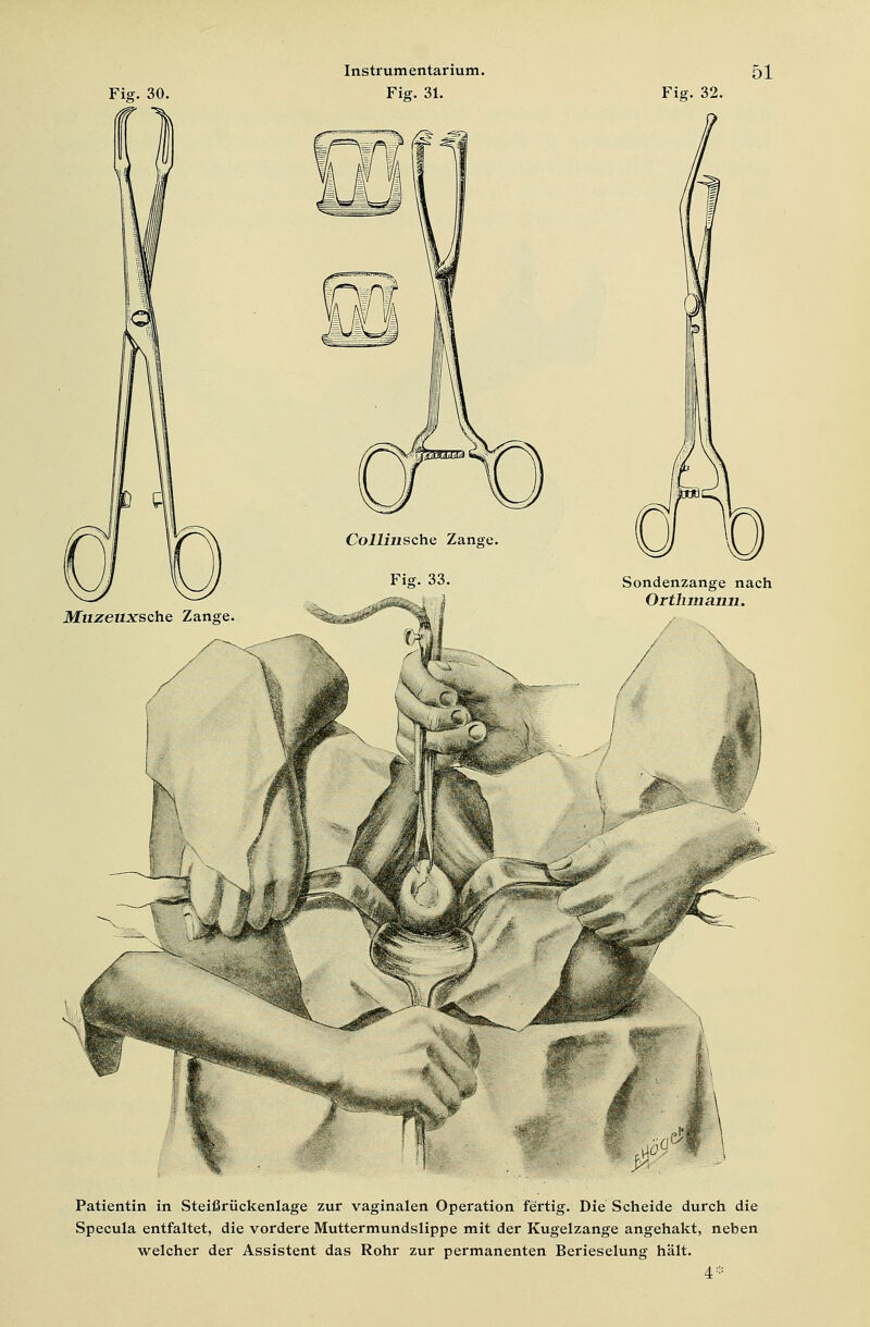 Fig. 30. Fig. 31. Fig. 32. Collinsche Zange. Fig. 33. Muzeuxsche Zange Sondenzange nach Orthmann. Patientin in Steißrückenlage zur vaginalen Operation fertig. Die Scheide durch die Specula entfaltet, die vordere Muttermundslippe mit der Kugelzange angehakt, neben welcher der Assistent das Rohr zur permanenten Berieselung hält. 4*