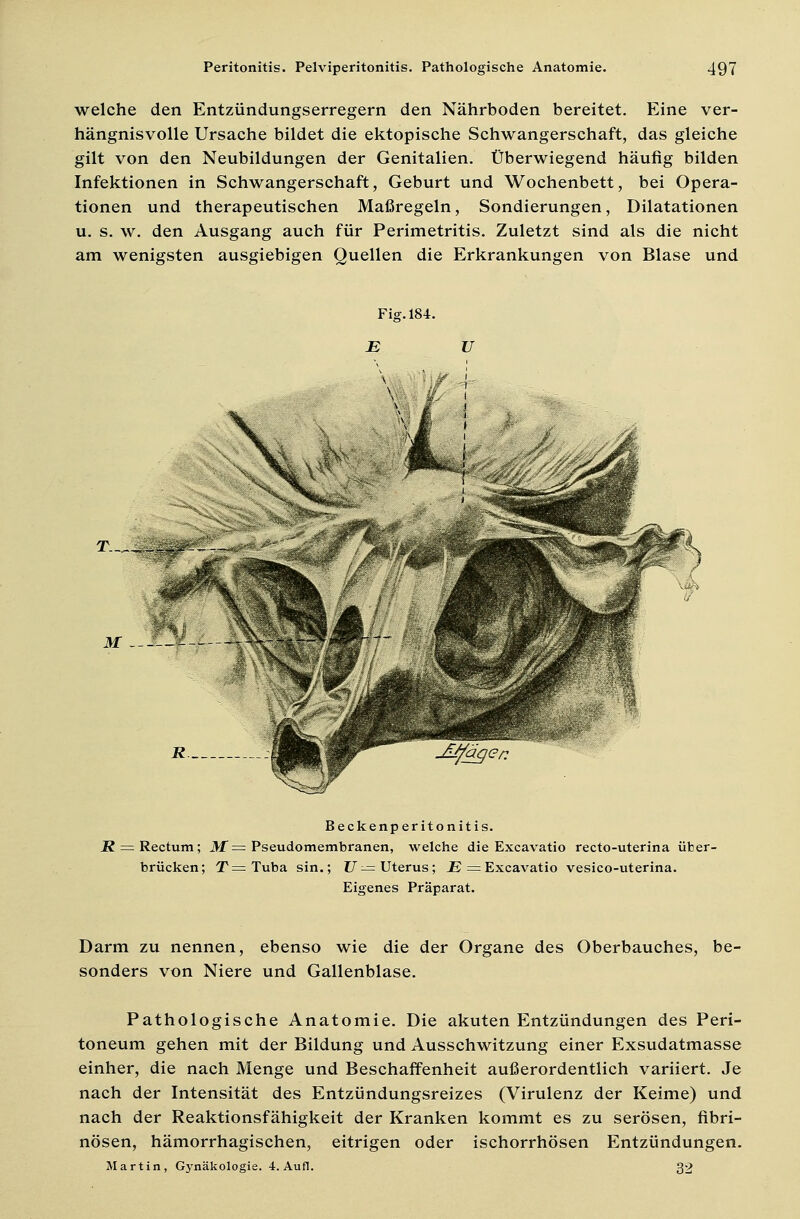 welche den Entzündungserregern den Nährboden bereitet. Eine ver- hängnisvolle Ursache bildet die ektopische Schwangerschaft, das gleiche gilt von den Neubildungen der Genitalien. Überwiegend häufig bilden Infektionen in Schwangerschaft, Geburt und Wochenbett, bei Opera- tionen und therapeutischen Maßregeln, Sondierungen, Dilatationen u. s. w. den Ausgang auch für Perimetritis. Zuletzt sind als die nicht am wenigsten ausgiebigen Quellen die Erkrankungen von Blase und Beckenperitonitis. R = Rectum; M= Pseudomembranen, welche die Excavatio recto-uterina über- brücken; T=Tuba sin.; U— Uterus; E = Excavatio vesico-uterina. Eigenes Präparat. Darm zu nennen, ebenso wie die der Organe des Oberbauches, be- sonders von Niere und Gallenblase. Pathologische Anatomie. Die akuten Entzündungen des Peri- toneum gehen mit der Bildung und Ausschwitzung einer Exsudatmasse einher, die nach Menge und Beschaffenheit außerordentlich variiert. Je nach der Intensität des Entzündungsreizes (Virulenz der Keime) und nach der Reaktionsfähigkeit der Kranken kommt es zu serösen, fibri- nösen, hämorrhagischen, eitrigen oder ischorrhösen Entzündungen. Martin, Gynäkologie. 4. Aufl. 32