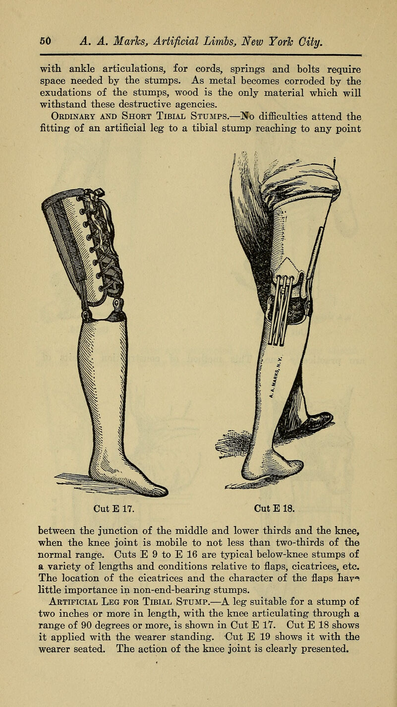 with ankle articulations, for cords, springs and bolts require space needed by the stumps. As metal becomes corroded by the exudations of the stumps, wood is the only material which will withstand these destructive agencies. Ordinary and Short Tibial Stumps.—No difficulties attend the fitting of an artificial leg to a tibial stump reaching to any point Cut E 17. Cut E 18. between the junction of the middle and lower thirds and the knee, when the knee joint is mobile to not less than two-thirds of the normal range. Cuts E 9 to E 16 are typical below-knee stumps of a variety of lengths and conditions relative to flaps, cicatrices, etc. The location of the cicatrices and the character of the flaps hav^ little importance in non-end-bearing stumps. Artificial Leg for Tibial Stump.—A leg suitable for a stump of two inches or more in length, with the knee articulating through a range of 90 degrees or more, is shown in Cut E 17. Cut E 18 shows it applied with the wearer standing. Cut E 19 shows it with the wearer seated. The action of the knee joint is clearly presented.