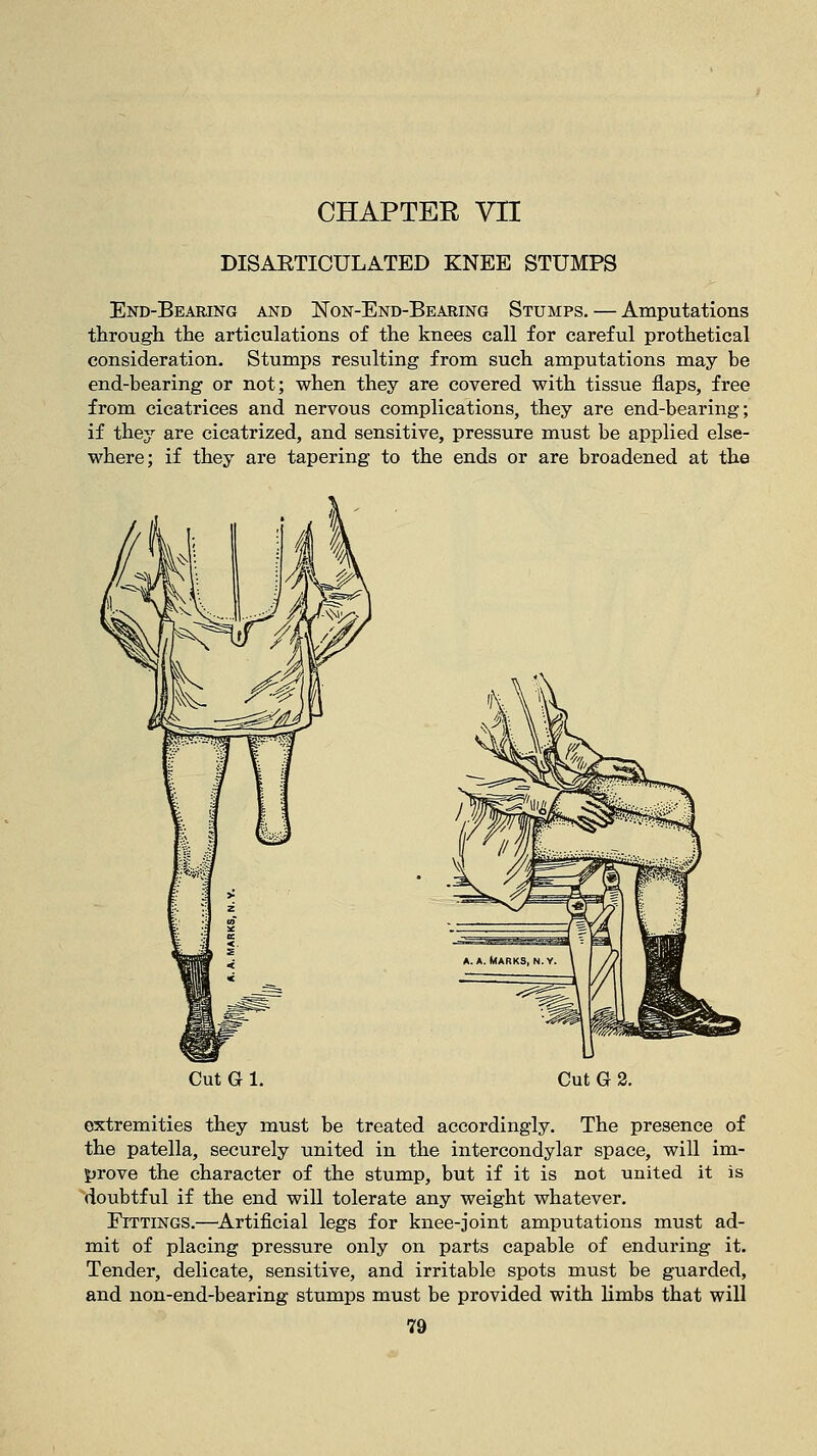 DISARTICULATED KNEE STUMPS End-Bearing and Non-End-Bearing Stumps. — Amputations through the articulations of the knees call for careful prothetical consideration. Stumps resulting from such amputations may be end-bearing or not; when they are covered with tissue flaps, free from cicatrices and nervous complications, they are end-bearing; if they are cicatrized, and sensitive, pressure must be applied else- where; if they are tapering to the ends or are broadened at the Cut G 1. Cut G 2. extremities they must be treated accordingly. The presence of the patella, securely united in the intercondylar space, will im- prove the character of the stump, but if it is not united it is doubtful if the end will tolerate any weight whatever. Fittings.—Artificial legs for knee-joint amputations must ad- mit of placing pressure only on parts capable of enduring it. Tender, delicate, sensitive, and irritable spots must be guarded, and non-end-bearing stumps must be provided with limbs that will