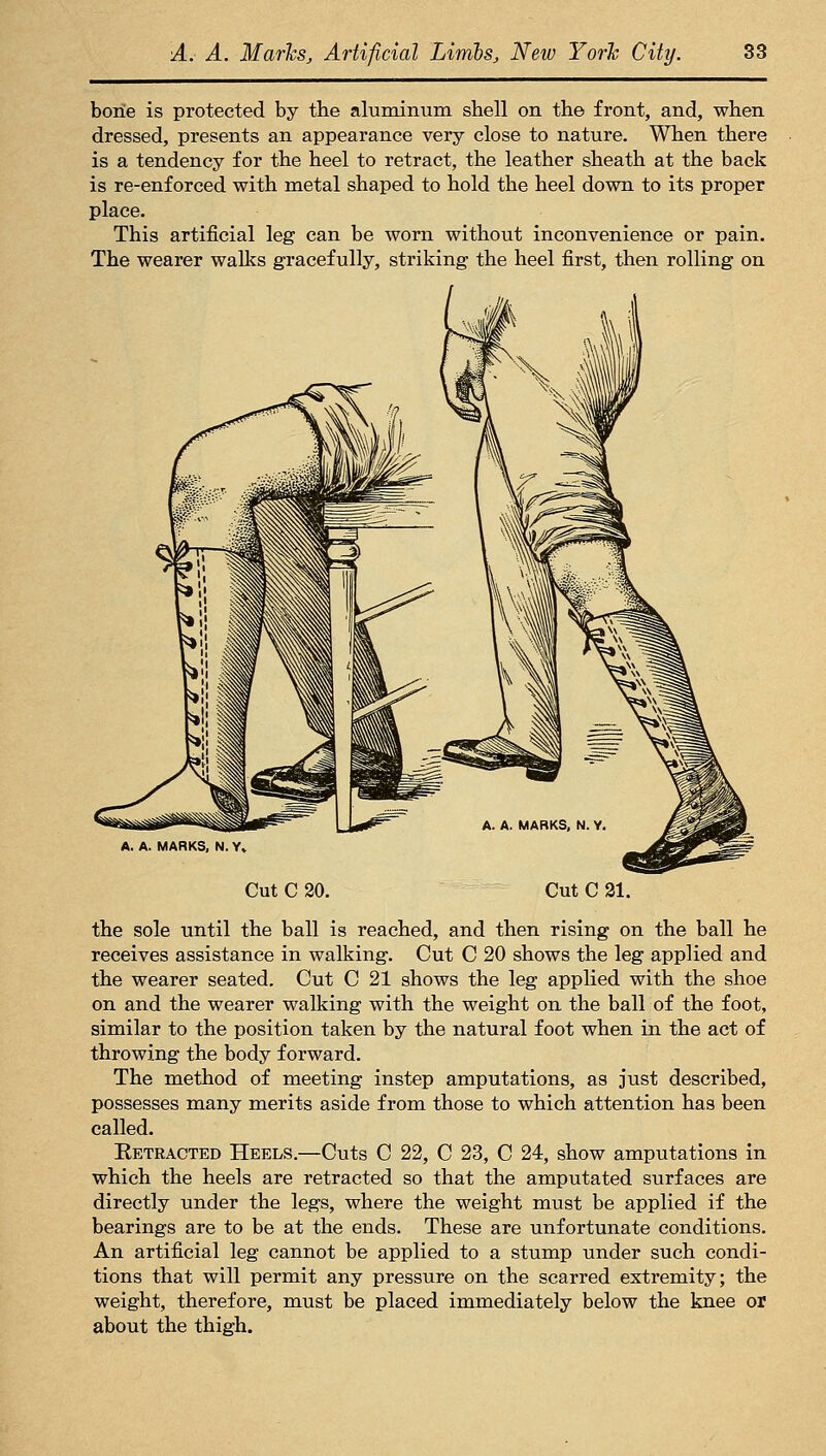 borie is protected by the aluminum shell on the front, and, when dressed, presents an appearance very close to nature. When there is a tendency for the heel to retract, the leather sheath at the back is re-enforced with metal shaped to hold the heel down to its proper place. This artificial leg can be worn without inconvenience or pain. The wearer walks gracefully, striking the heel first, then rolling on A. A. MARKS, N. Y» Cut C 20. Cut C 21. the sole until the ball is reached, and then rising on the ball he receives assistance in walking. Cut C 20 shows the leg applied and the wearer seated. Cut C 21 shows the leg applied with the shoe on and the wearer walking with the weight on the ball of the foot, similar to the position taken by the natural foot when in the act of throwing the body forward. The method of meeting instep amputations, as just described, possesses many merits aside from those to which attention has been called. Eetracted Heels.—Cuts C 22, C 23, C 24, show amputations in which the heels are retracted so that the amputated surfaces are directly under the legs, where the weight must be applied if the bearings are to be at the ends. These are unfortunate conditions. An artificial leg cannot be applied to a stump under such condi- tions that will permit any pressure on the scarred extremity; the weight, therefore, must be placed immediately below the knee or about the thigh.