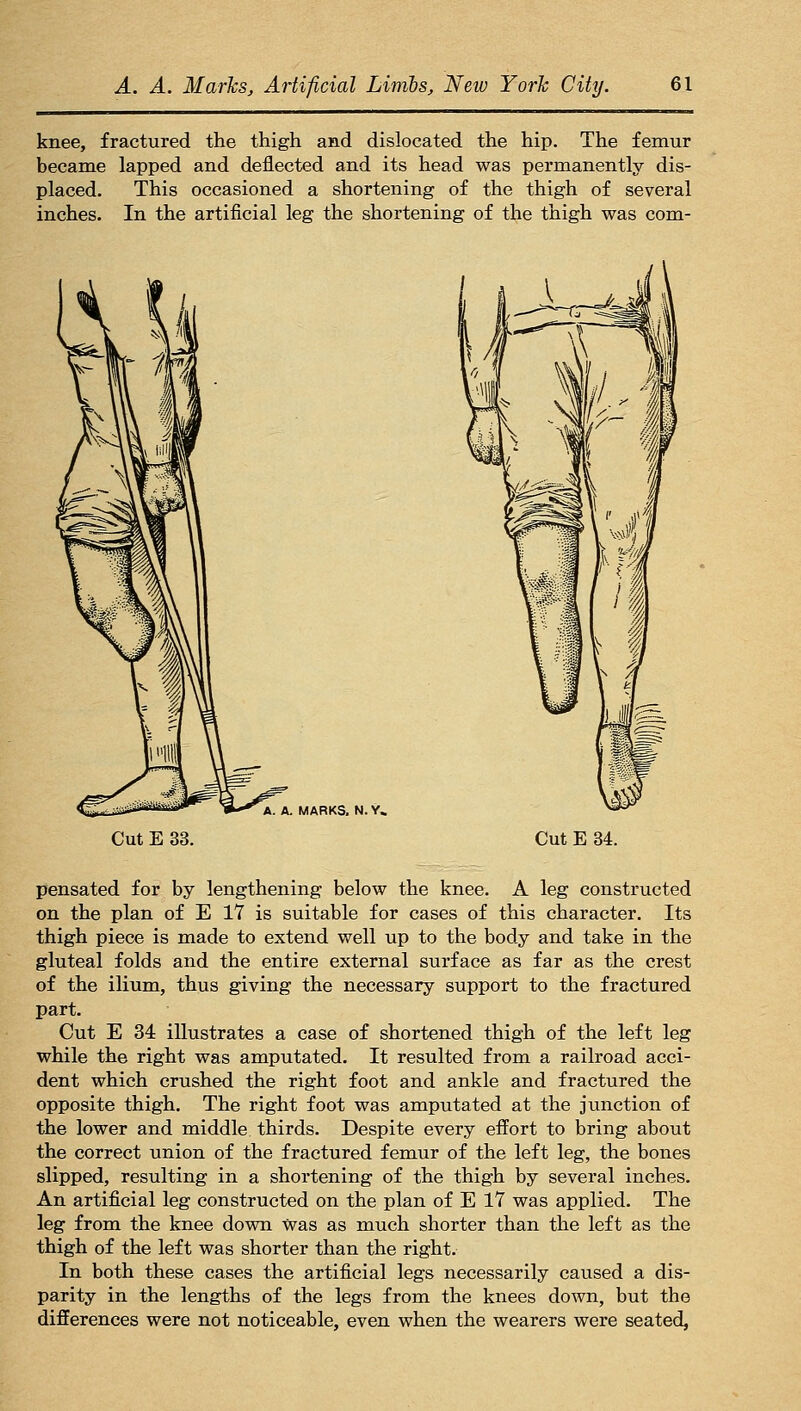 knee, fractured the thigh and dislocated the hip. The femur became lapped and deflected and its head was permanently dis- placed. This occasioned a shortening of the thigh of several inches. In the artificial leg the shortening of the thigh was com- A. A. MARKS. N. Y« Cut E 33. Cut E 34. pensated for by lengthening below the knee. A leg constructed on the plan of E 17 is suitable for cases of this character. Its thigh piece is made to extend well up to the body and take in the gluteal folds and the entire external surface as far as the crest of the ilium, thus giving the necessary support to the fractured part. Cut E 34 illustrates a case of shortened thigh of the left leg while the right was amputated. It resulted from a railroad acci- dent which crushed the right foot and ankle and fractured the opposite thigh. The right foot was amputated at the junction of the lower and middle thirds. Despite every effort to bring about the correct union of the fractured femur of the left leg, the bones slipped, resulting in a shortening of the thigh by several inches. An artificial leg constructed on the plan of E 17 was applied. The leg from the knee dovpn was as much shorter than the left as the thigh of the left was shorter than the right. In both these cases the artificial legs necessarily caused a dis- parity in the lengths of the legs from the knees down, but the differences were not noticeable, even when the wearers were seated,