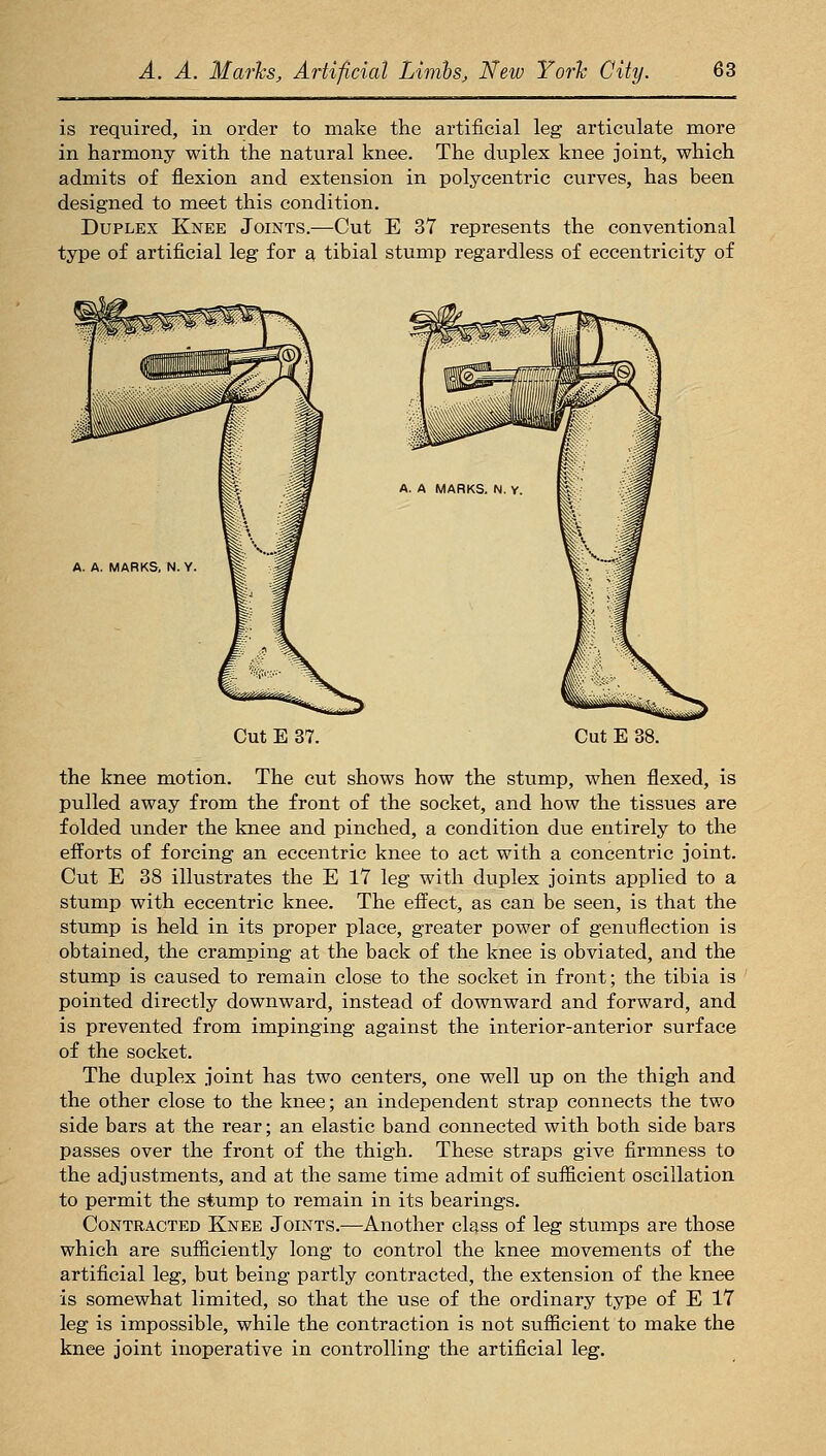 is required, in order to make the artificial leg articulate more in harmony with the natural knee. The duplex knee joint, which admits of flexion and extension in polycentric curves, has been designed to meet this condition. Duplex Knee Joints.—Cut E 37 represents the conventional type of artificial leg for a, tibial stump regardless of eccentricity of A. A. MARKS, N. Y, Cut E 37. Cut E 38. the knee motion. The cut shows how the stump, when flexed, is pulled away from the front of the socket, and how the tissues are folded under the knee and pinched, a condition due entirely to the efforts of forcing an eccentric knee to act with a concentric joint. Cut E 38 illustrates the E 17 leg with duplex joints applied to a stump with eccentric knee. The effect, as can be seen, is that the stump is held in its proper place, greater power of genuflection is obtained, the cramping at the back of the knee is obviated, and the stump is caused to remain close to the socket in front; the tibia is pointed directly downward, instead of downward and forward, and is prevented from impinging against the interior-anterior surface of the socket. The duplex joint has two centers, one well up on the thigh and the other close to the knee; an independent strap connects the two side bars at the rear; an elastic band connected with both side bars passes over the front of the thigh. These straps give firmness to the adjustments, and at the same time admit of sufficient oscillation to permit the stump to remain in its bearings. Contracted Knee Joints.—Another class of leg stumps are those which are sufficiently long to control the knee movements of the artificial leg, but being partly contracted, the extension of the knee is somewhat limited, so that the use of the ordinary type of E 17 leg is impossible, while the contraction is not siifficient to make the knee joint inoperative in controlling the artificial leg.