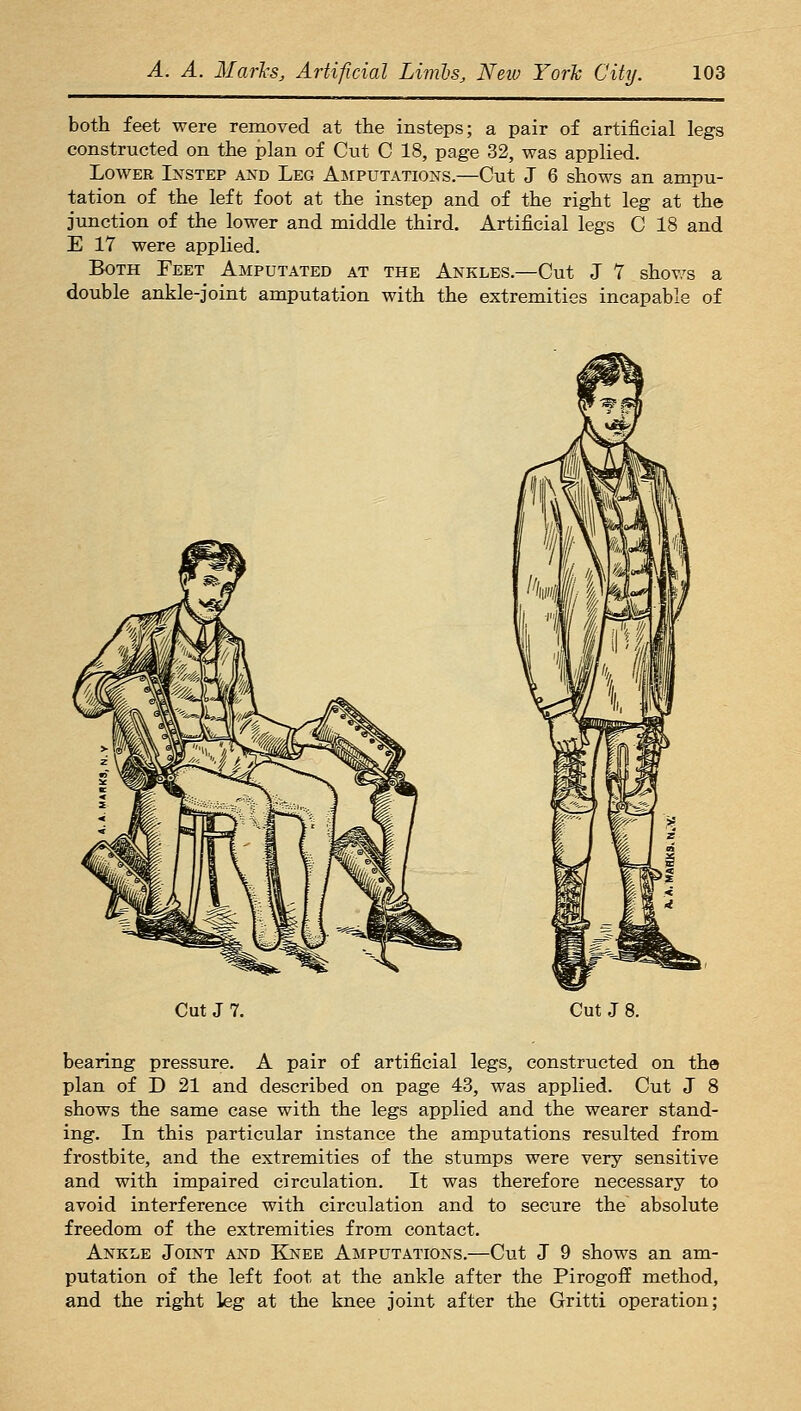 both feet were removed at the insteps; a pair of artificial legs constructed on the plan of Cut C 18, page 32, was applied. Lower Instep and Leg Aiiputations.—Cut J 6 shows an ampu- tation of the left foot at the instep and of the right leg at the junction of the lower and middle third. Artificial legs C 18 and E 17 were applied. Both Feet Amputated at the Ankles.—Cut J 7 shov/s a double ankle-joint amputation with the extremities incapable of Cut J 7. Cut J 8. bearing pressure. A pair of artificial legs, constructed on the plan of D 21 and described on page 43, was applied. Cut J 8 shows the same case with the legs applied and the wearer stand- ing. In this particular instance the amputations resulted from frostbite, and the extremities of the stumps were very sensitive and with impaired circulation. It was therefore necessary to avoid interference with circulation and to secure the absolute freedom of the extremities from contact. Ankle Joint and E[nee Amputations.—Cut J 9 shows an am- putation of the left foot at the ankle after the PirogofP method, and the right leg at the knee joint after the Gritti operation;