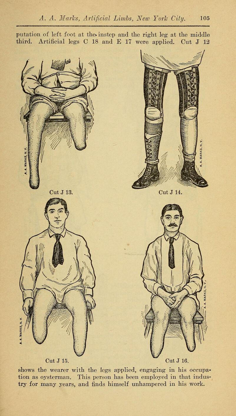 putation of left foot at the> instep and the right leg at the middle third. Artificial legs C 18 and E 17 were applied. Cut J 12 Cut J 14. Cut J 15. Cut J 16. shows the wearer with the legs applied, engaging in his occupa- tion as oysterman. This person has been employed in that indus- try for many years, and finds himself unhampered in his work.