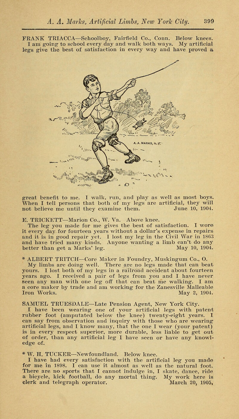 FEANK TRIACCA—Schoolboy, Fairfield Co., Conn. Below knees. I am g'oing to school every day and walk both ways. My artificial legs give the best of satisfaction in every way and have proved a 1^^!:''.« ' **\^?' great benefit to me. I walk, run, and play as well as most boys. When I tell persons that both of my legs are artificial, they will not believe me until they examine them. June 10, 1904. E. TEICKETT—Marion Co., W. Va. Above knee. The leg you made for me gives the best of satisfaction. I wore it every day for fourteen years without a dollar's expense in repairs and it is in good repair yet. I lost my leg in the Civil War in 1863 and have tried many kinds. Anyone wanting a limb can't do any better than get a Marks' leg. May 10, 1904, * ALBERT TRITCH—Core Maker in Foundry, Muskingum Co., 0. My limbs are doing well. There are no legs made that can beat yours. I lost both of my legs in a railroad accident about fourteen years ago. I received a pair of legs from you and I have never seen any man with one leg ofl: that can beat rhe walking. I am a core maker by trade and am worki-ng for the Zanesville Malleable Iron Works. May 2, 1904. SAMUEL TRUESDALE—Late Pension Agent, New York City. I have been wearing one of your artificial legs with patent rubber foot (amputated below the knee) twenty-eight years. I can say from observation and inquiry with those who are wearing artificial legs, and I know many, that the one I wear (your patent) is in every respect superior, more durable, less liable to get out of order, than any artificial leg I have seen or have any knowl- edge of. * W. H. TUCKER—Newfoundland. Below knee. I have had every satisfaction with the artificial leg you made for me in 1898. I can use it almost as well as the natural foot. There are no sports that I cannot indulge in, I skate, dance, ride a bicycle, kick football, do any mortal thing. My work here is clerk and telegraph operator. March 20, 1905,