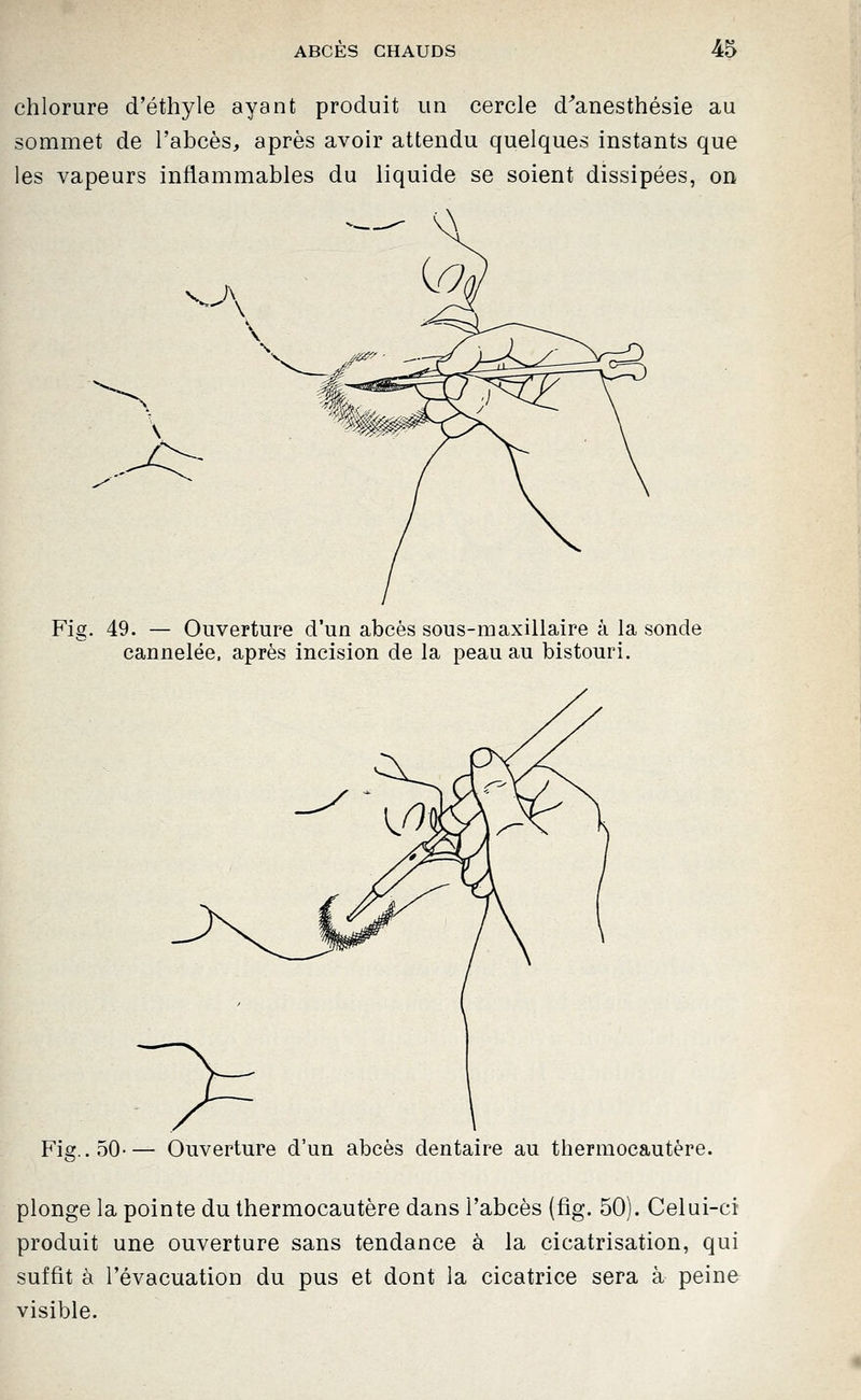 chlorure d'éthyle ayant produit un cercle d^'anesthésie au sommet de l'abcès, après avoir attendu quelques instants que les vapeurs inflammables du liquide se soient dissipées, on Fig. 49. — Ouverture d'un abcès sous-maxillaire à la sonde cannelée, après incision de la peau au bistouri. Fig.. 50— Ouverture d'un abcès dentaire au thermocautère. plonge la pointe du thermocautère dans l'abcès (fig. 50). Celui-ci produit une ouverture sans tendance à la cicatrisation, qui suffit à l'évacuation du pus et dont la cicatrice sera à peine visible.