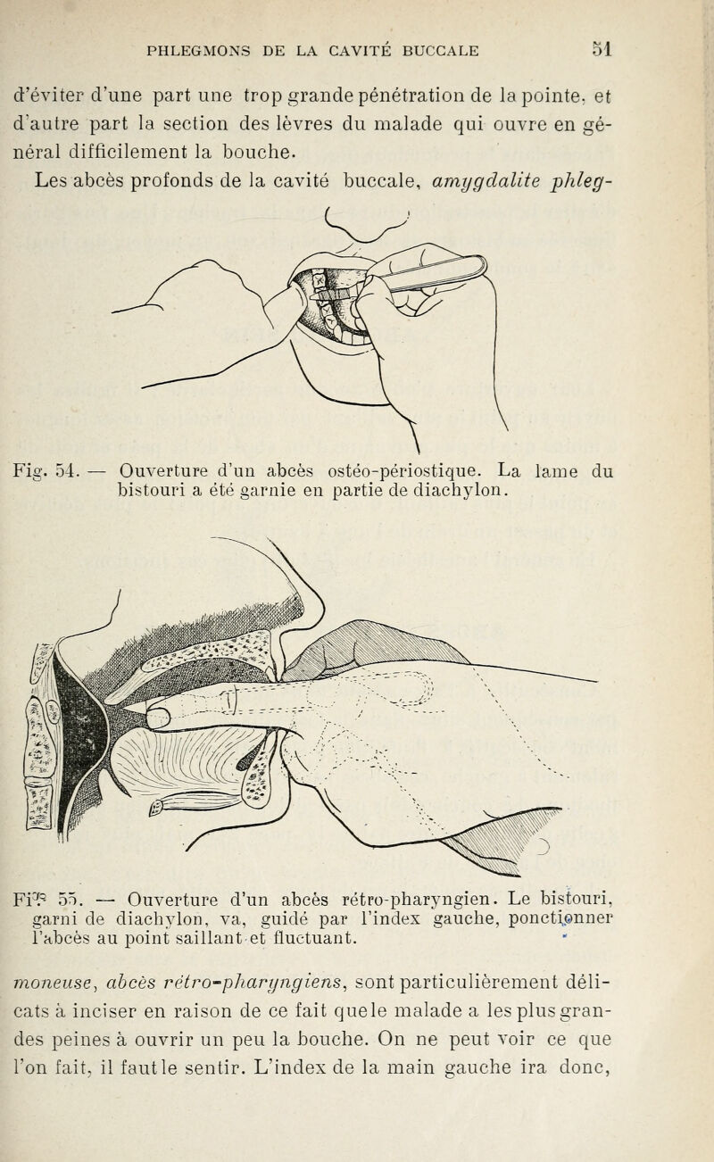 d'éviter d'une part une trop grande pénétration de la pointe, et d'autre part la section des lèvres du malade qui ouvre en gé- néral difficilement la bouche. Les abcès profonds de la cavité buccale, amygdalite phleg- Fiff. 54. Ouverture d'un abcès ostéo-périostique. La lame du bistouri a été garnie en partie de diachylon. Fi'^^ 55. — Ouverture d'un abcès rétro-pharyngien. Le bistouri, garni de diachylon, va, guidé par l'index gauche, ponctionner l'abcès au point saillant et fluctuant. moneuse^ abcès rétro-phari/iigiens, sont particulièrement déli- cats à inciser en raison de ce fait quele malade a les plus gran- des peines à ouvrir un peu la bouche. On ne peut voir ce que l'on fait, il faut le sentir. L'index de la main gauche ira donc,