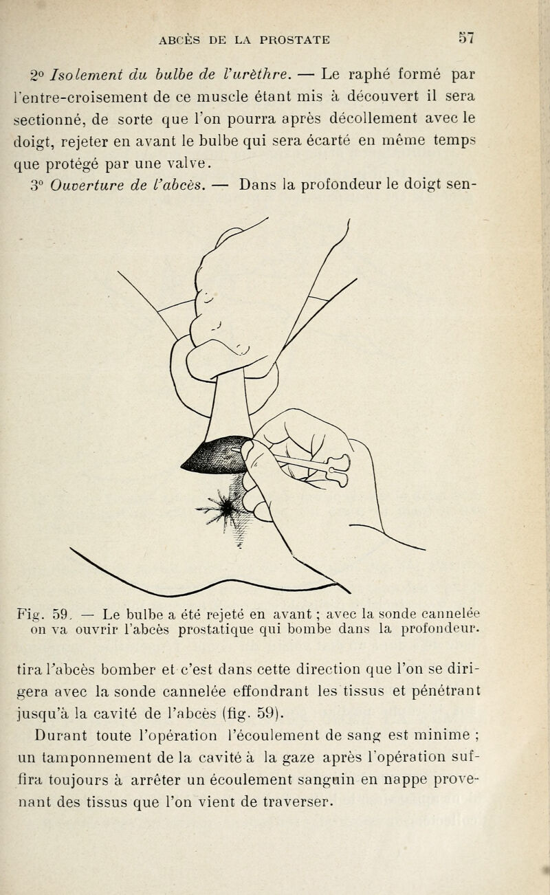 2^ Isolement du bulbe de Vurèthre. — Le raphé formé par lentre-croisement de ce muscle étant mis à découvert il sera sectionné, de sorte que l'on pourra après décollement avec le doigt, rejeter en avant le bulbe qui sera écarté en même temps que protégé par une valve. 3° Ouverture de l'abcès. — Dans la profondeur le doigt sen- Fig. 59, — Le bulbe a été rejeté en avant ; avec la sonde cannelée on va ouvrir l'abcès prostatique qui bombe dans la profondeur. tira Tabcès bomber et c'est dans cette direction que l'on se diri- gera avec la sonde cannelée effondrant les tissus et pénétrant jusqu'à la cavité de l'abcès (fîg. 59). Durant toute l'opération l'écoulement de sang est minime ; un tamponnement de la cavité à la gaze après l'opération suf- fira toujours à arrêter un écoulement sanguin en nappe prove- nant des tissus que l'on vient de traverser.
