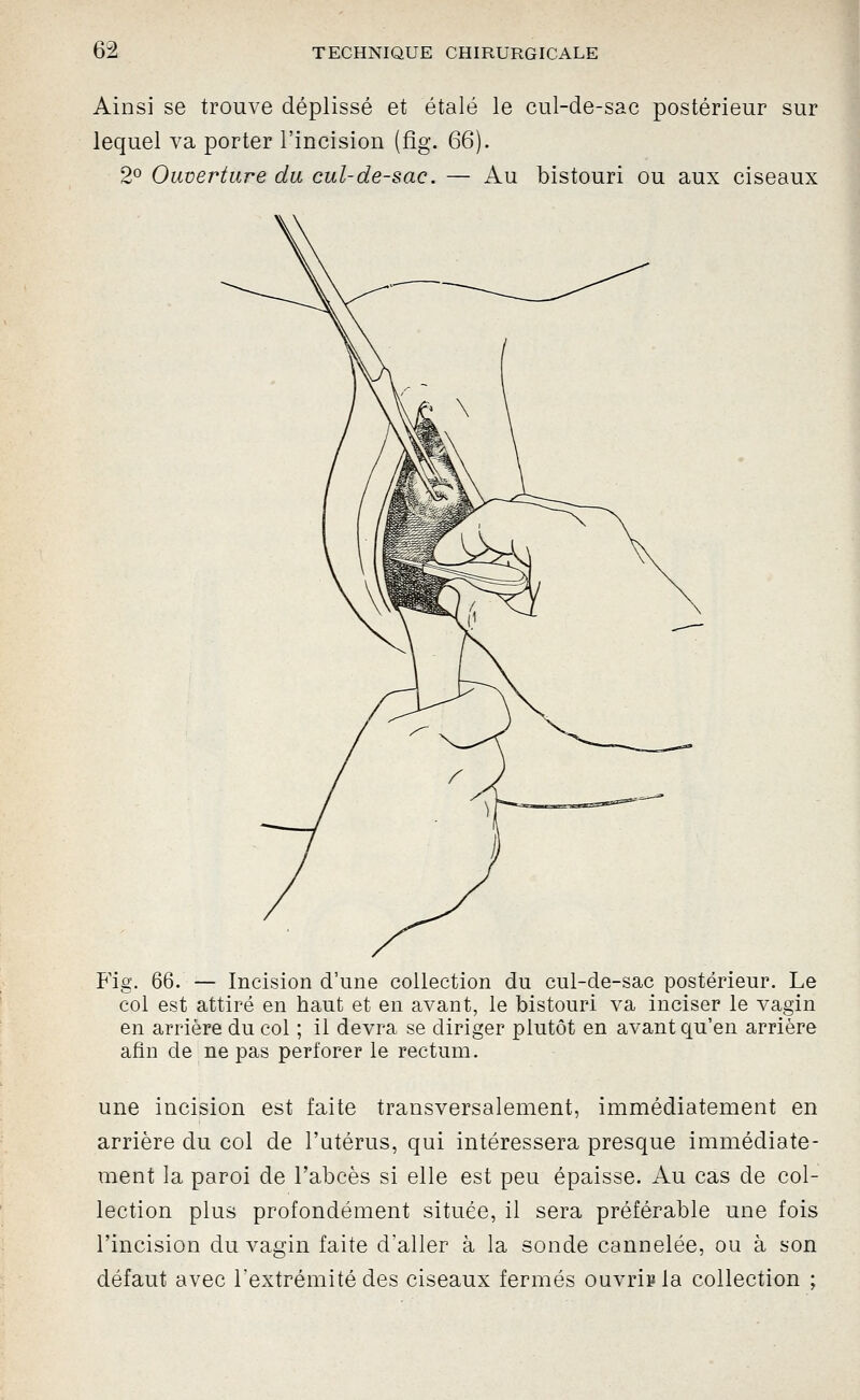 Ainsi se trouve déplissé et étalé le cul-de-sac postérieur sur lequel va porter l'incision (fig. 66). 2° Ouverture du cul-de-sac. — Au bistouri ou aux ciseaux Fig. 66. — Incision d'une collection du cul-de-sac postérieur. Le col est attiré en haut et en avant, le bistouri va inciser le vagin en arrière du col ; il devra se diriger plutôt en avant qu'en arrière afin de ne pas perforer le rectum. une incision est faite transversalement, immédiatement en arrière du col de l'utérus, qui intéressera presque immédiate- ment la paroi de l'abcès si elle est peu épaisse. Au cas de col- lection plus profondément située, il sera préférable une fois l'incision du vagin faite d'aller à la sonde cannelée, ou à son défaut avec l'extrémité des ciseaux fermés ouvris la collection ;