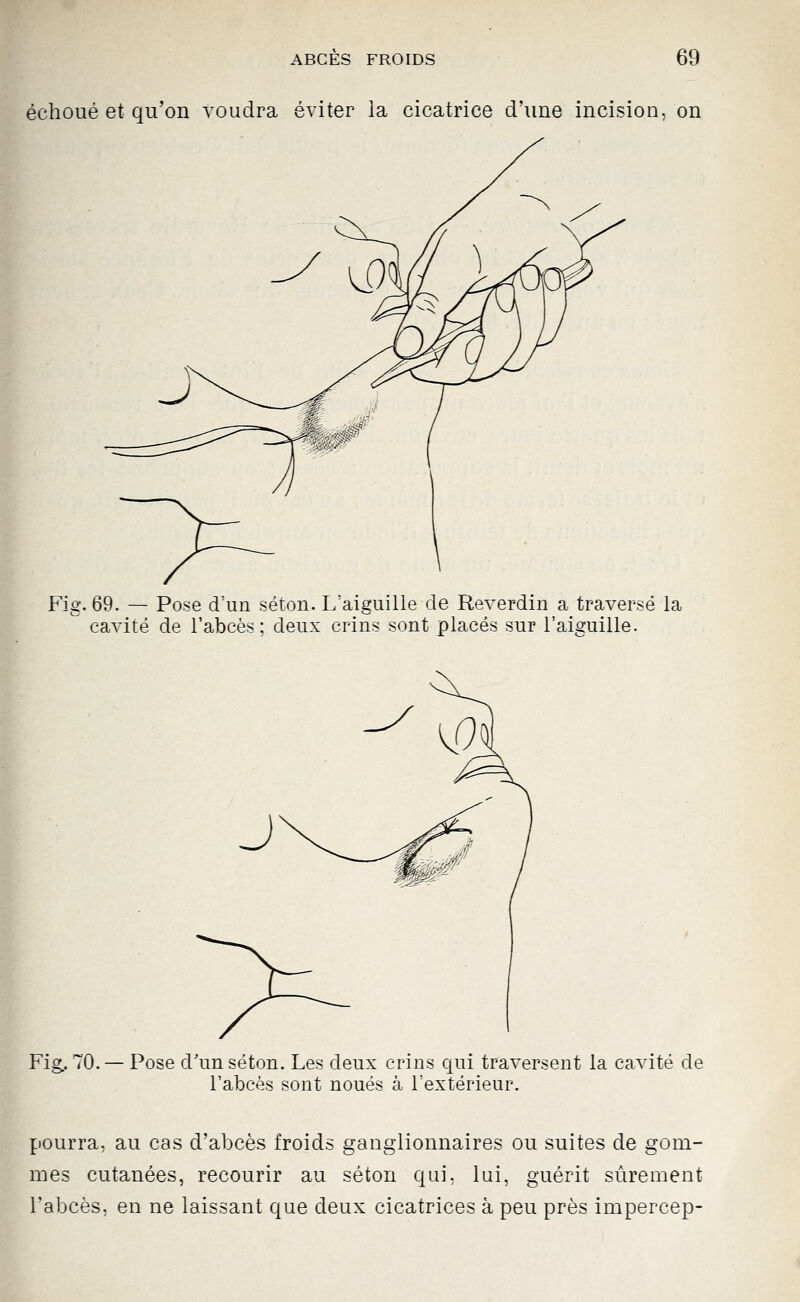 échoué et qu'on voudra éviter la cicatrice d'une incision, on ¥ Fig. 69. — Pose d'un séton. L'aiguille de Reverdin a traversé la cavité de l'abcès; deux crins sont placés sur l'aiguille. Fig. 70. — Pose d'un séton. Les deux crins qui traversent la cavité de l'abcès sont noués à l'extérieur. pourra, au cas d'abcès froids ganglionnaires ou suites de gom- mes cutanées, recourir au séton qui, lui, guérit siirement l'abcès, en ne laissant que deux cicatrices à peu près impercep-