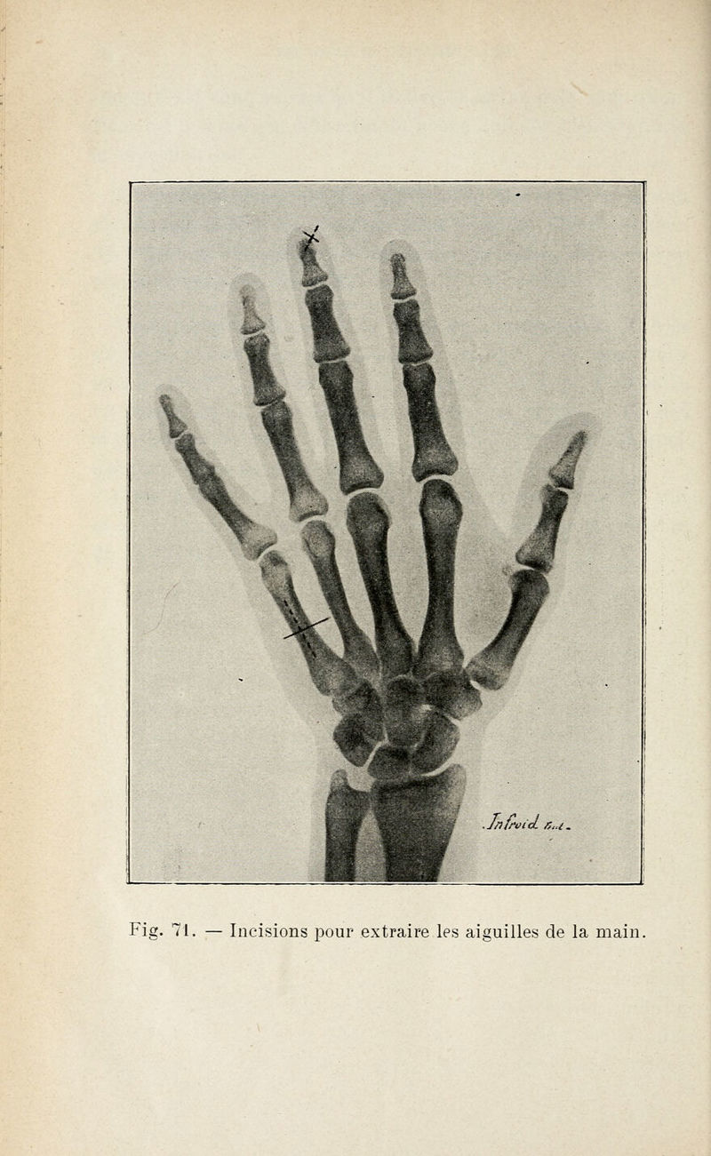 Fig. 71. — Incisions pour extraire les aiguilles de la main.