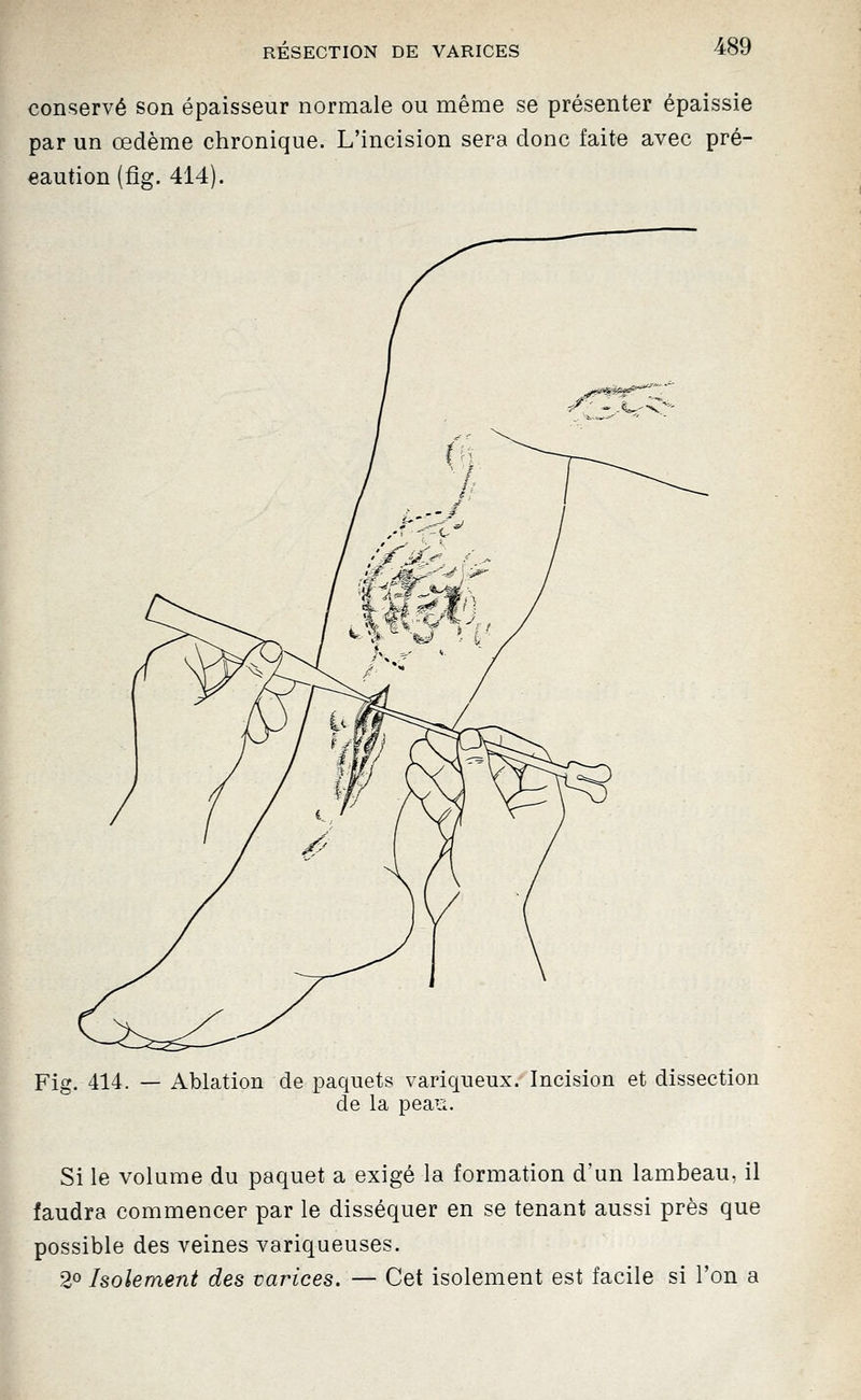conservé son épaisseur normale ou même se présenter épaissie par un œdème chronique. L'incision sera donc faite avec pré- caution (fig. 414). Fig. 414. — Ablation de paquets variqueux. Incision et dissection de la pean. Si le volume du paquet a exigé la formation d'un lambeau, il faudra commencer par le disséquer en se tenant aussi près que possible des veines variqueuses. 20 Isolement des varices. — Cet isolement est facile si l'on a